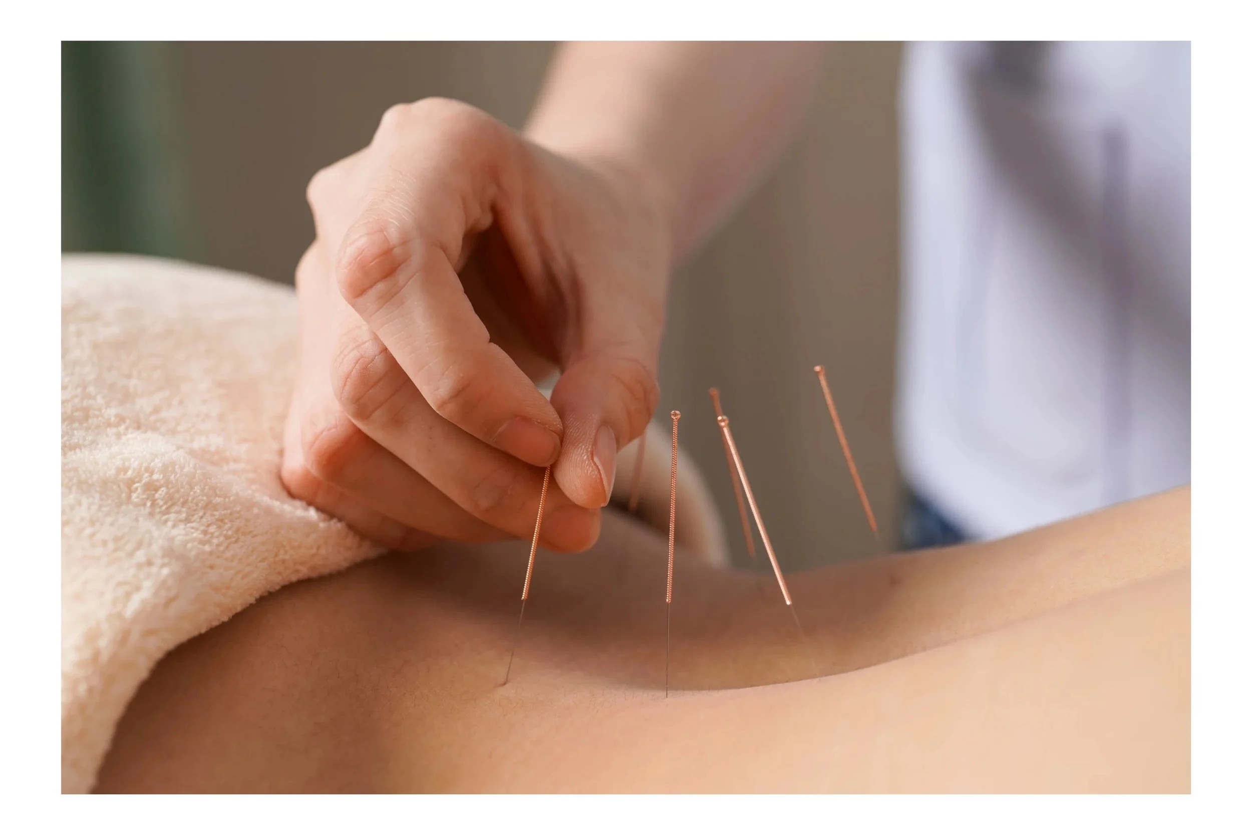 O Papel da Acupuntura na Prevenção da Doença e na Manutenção do Bem-Estar