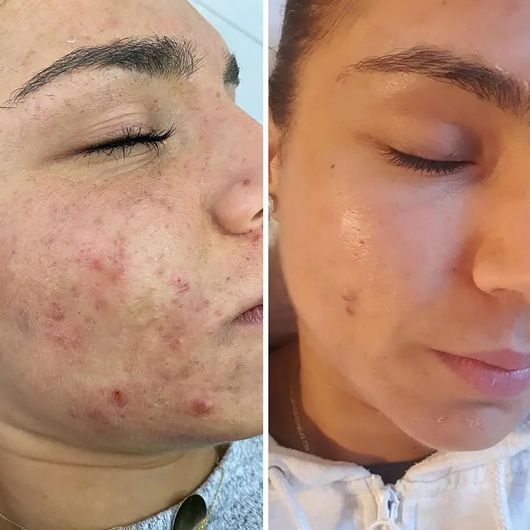 Algae: a gentle reset for your skin 
These before and after results show the power of the D&Eacute;CAAR Algae Peel, a treatment that encourages natural renewal, smooths texture, and restores a healthy glow.
These images are kindly provided by D&Eacut