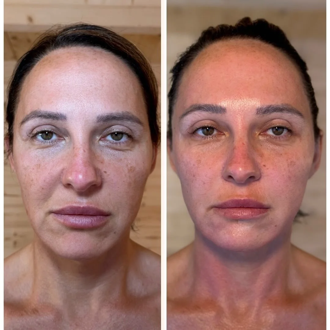 Before &amp; after the Lift Facial 

It wasn&rsquo;t about changing her face, but revealing her natural radiance.
 Brighter skin, softened contours, a gentle lift - the kind that looks effortless.

A reminder of how luminous you can be.

Lauren x