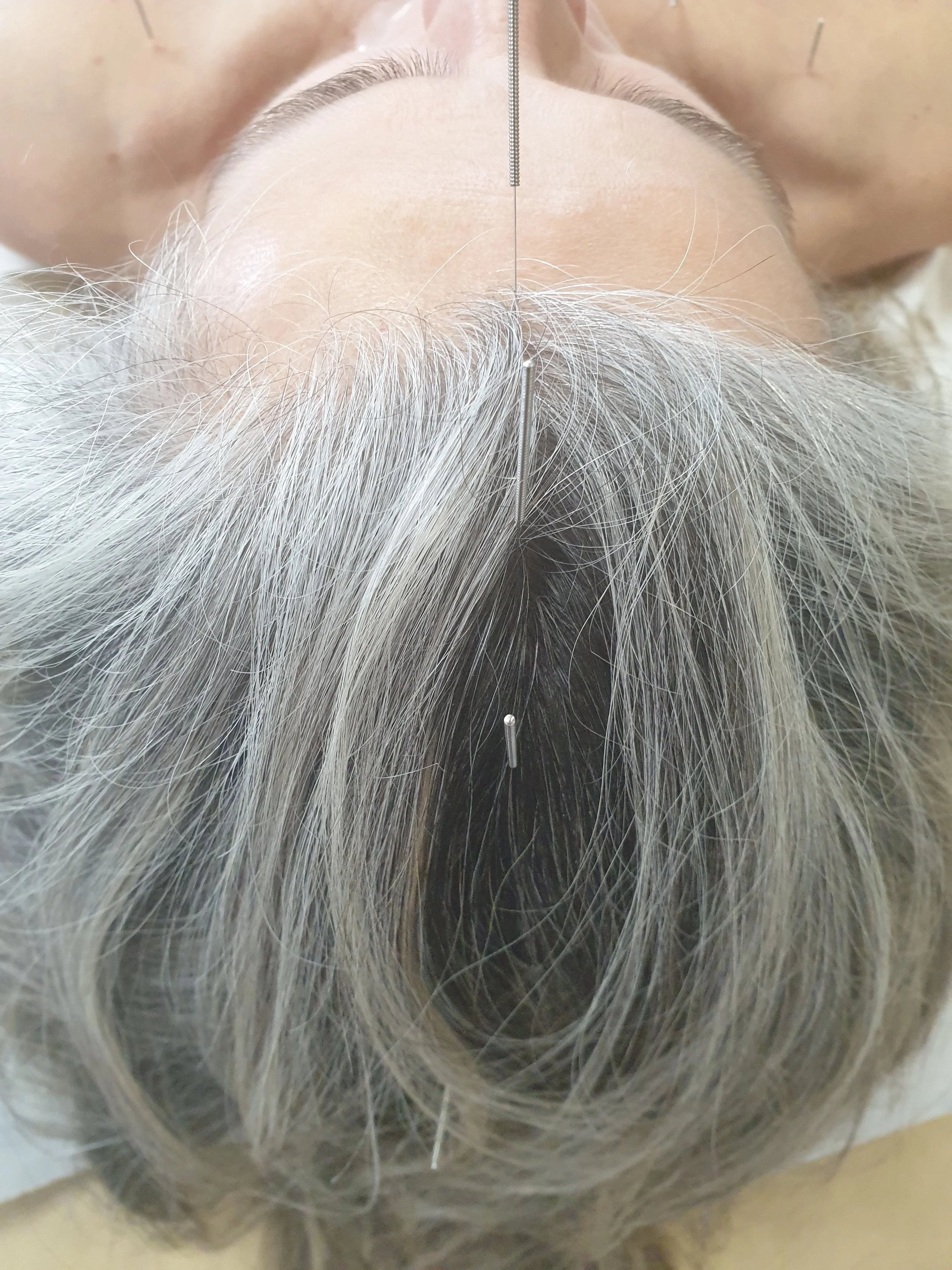 Acupuncturist put needles in clients head to strengthen kidney function