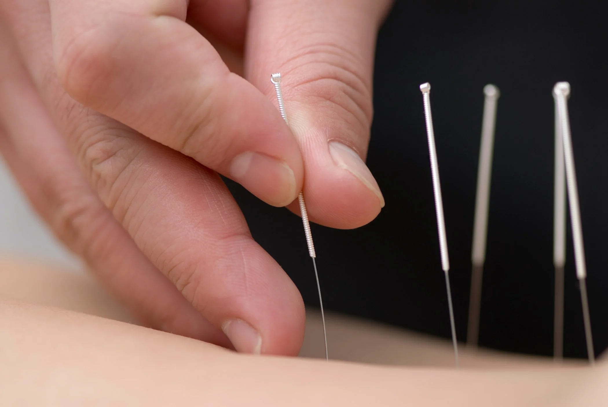 Acupuncturist putting needles on the clients back