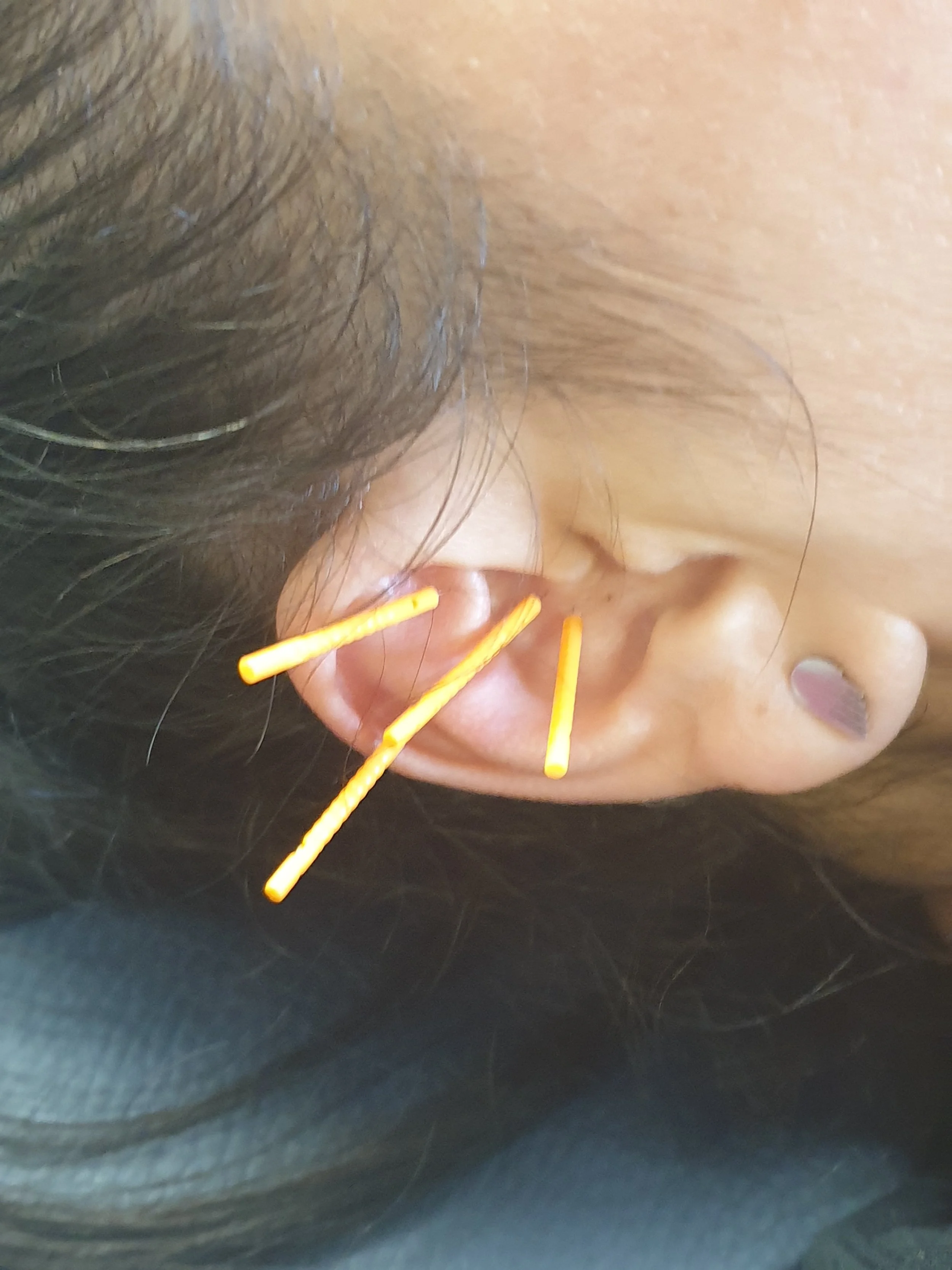 Acupuncturist put ear needles in clients ear