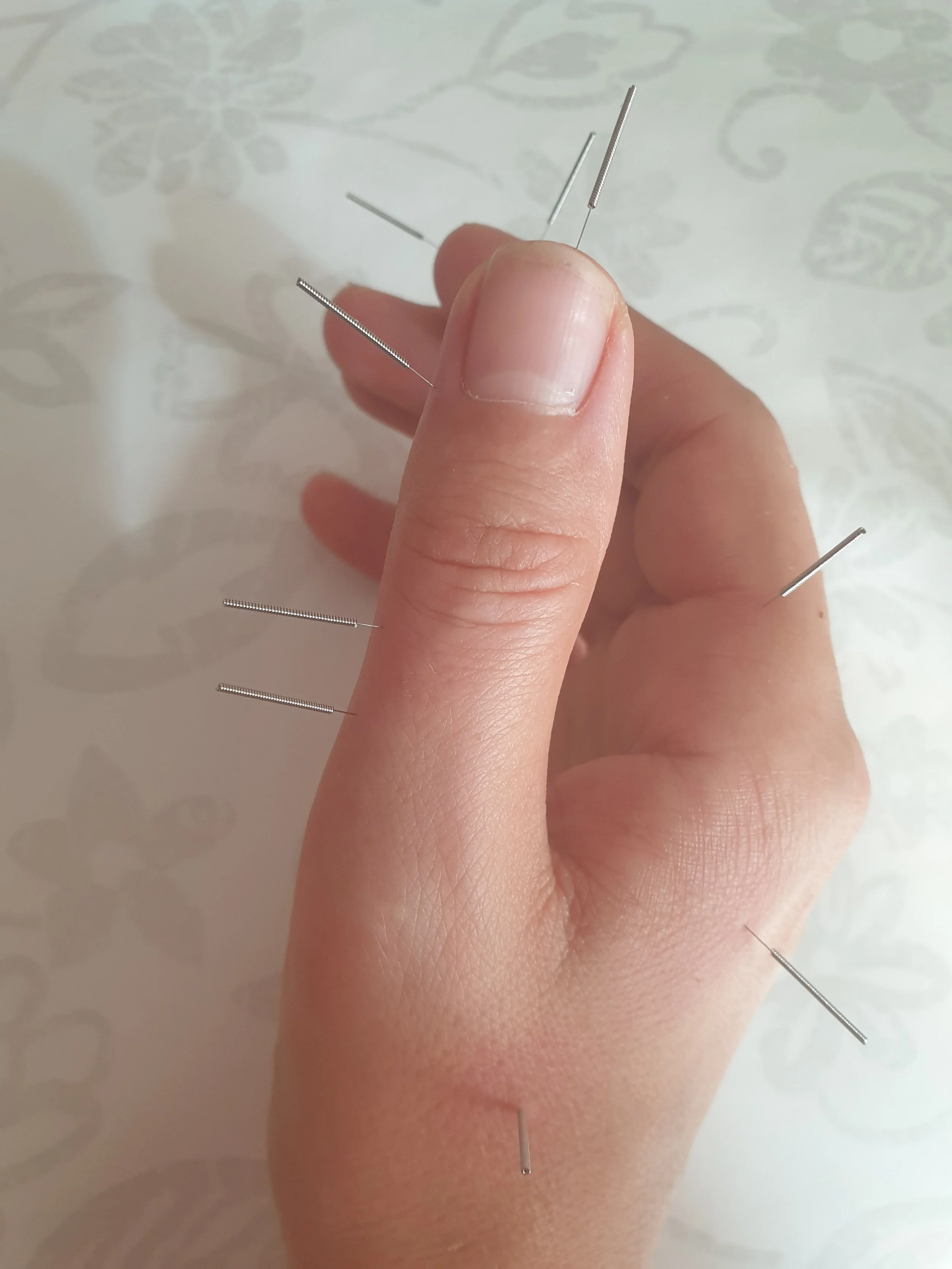 Acupuncture on clients thumb and index finger for numbness and poor circulation