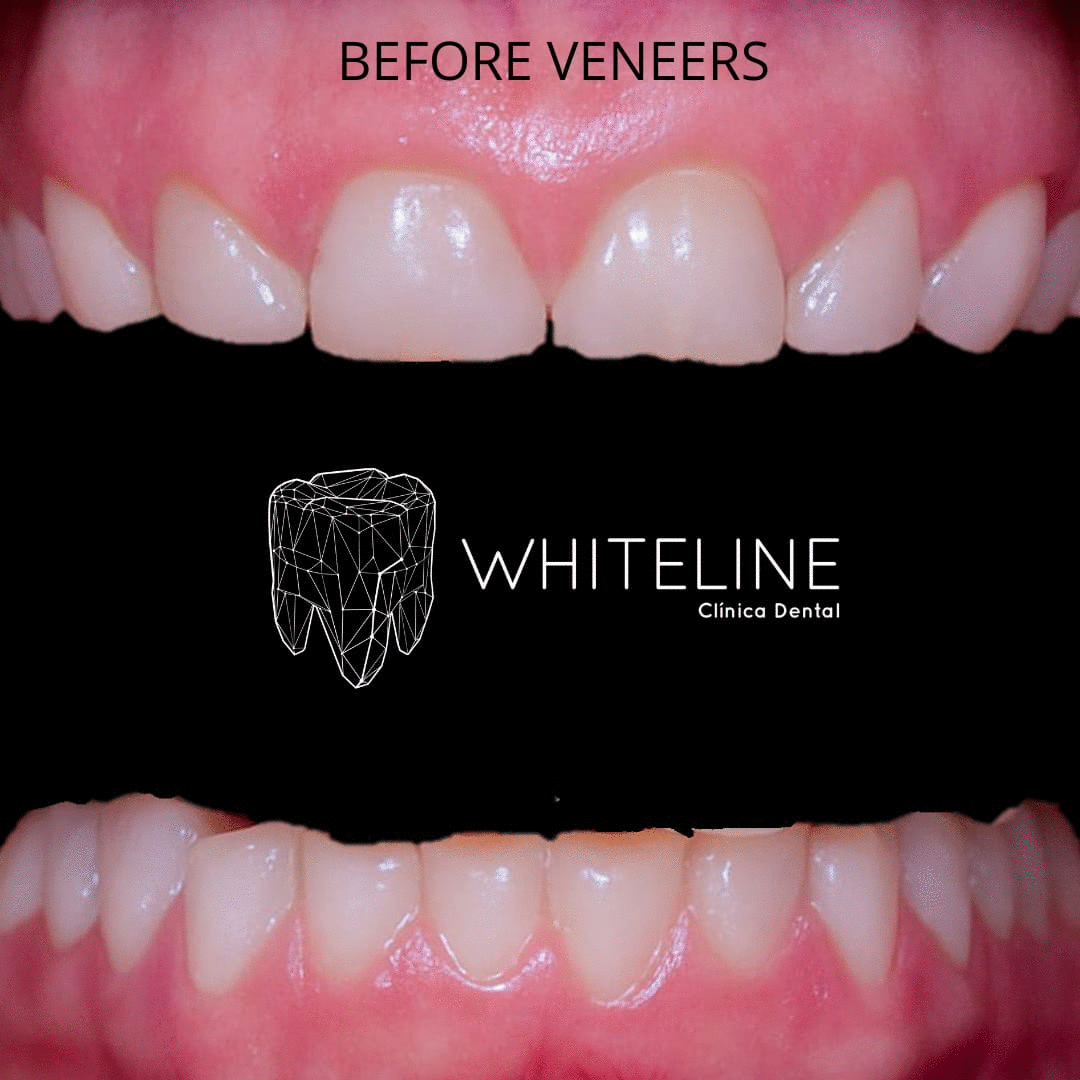 Aesthetic Transformation with Porcelain Veneers: Whiteline Case Study