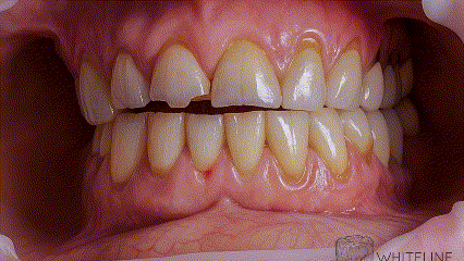 Caso Clínico Whiteline: La Transformación Completa de Julie con Coronas de Zirconia