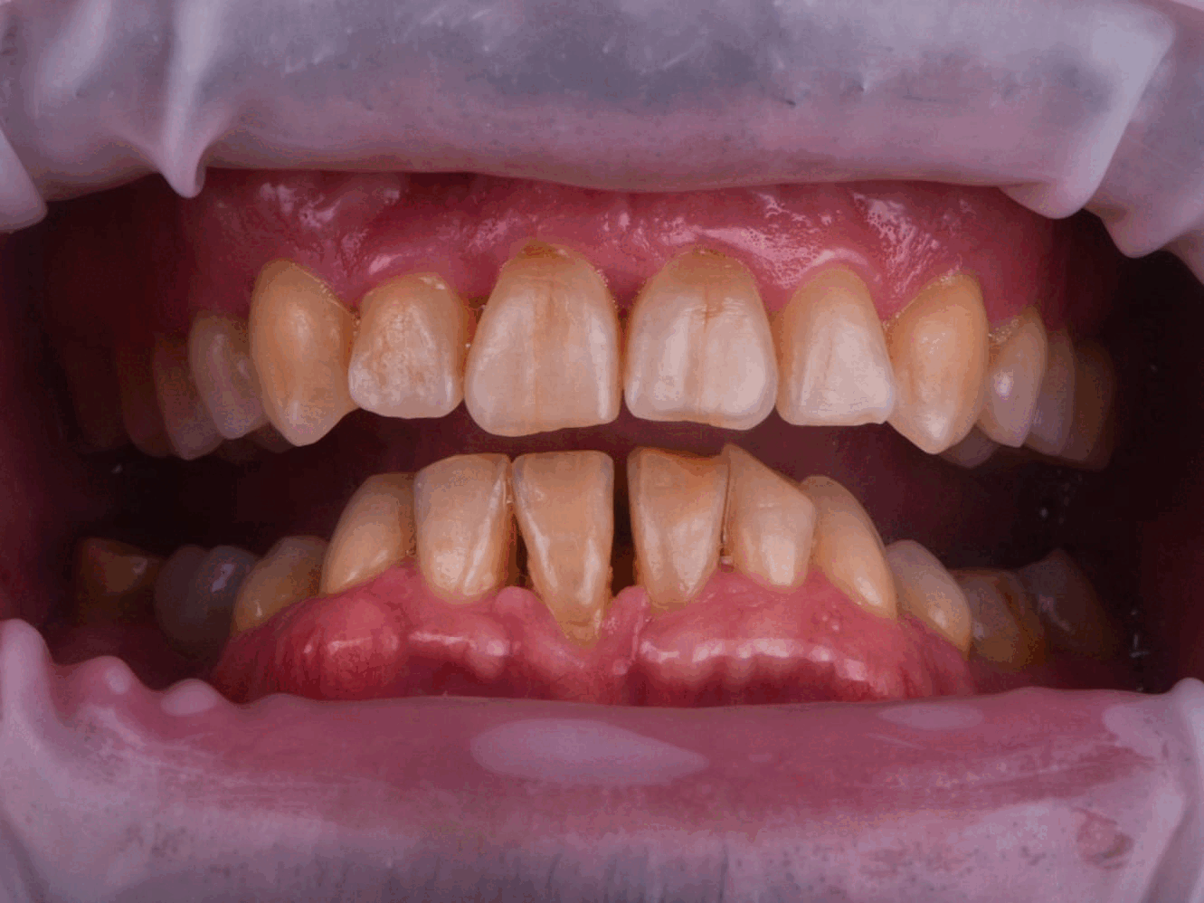 Caso Clínico Whiteline: La Transformación Integral de Vlad con Ortodoncia y Coronas de Zirconia