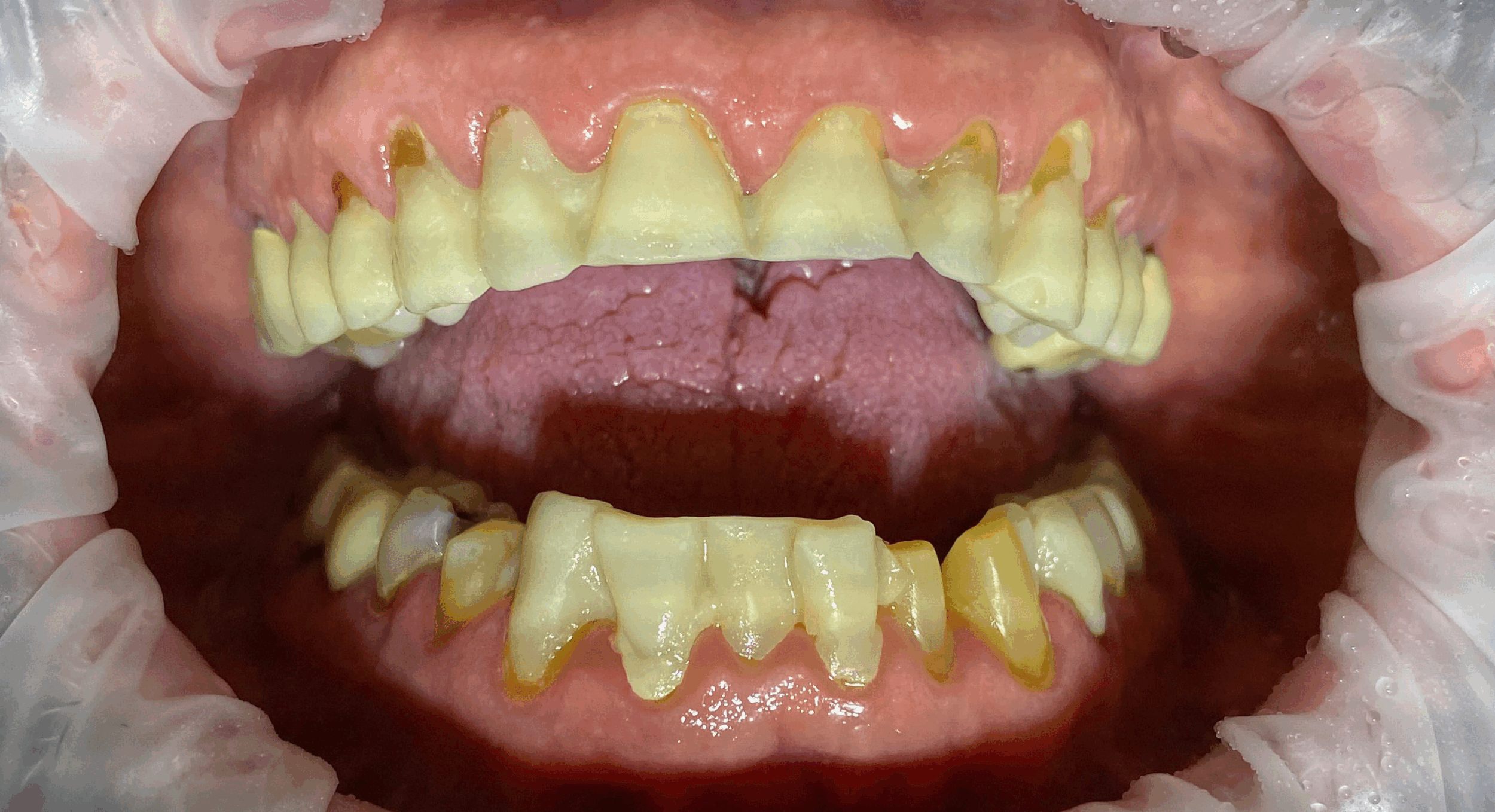 Caso Clínico Whiteline: La Impresionante Transformación de Brian con 18 Coronas de Zirconia