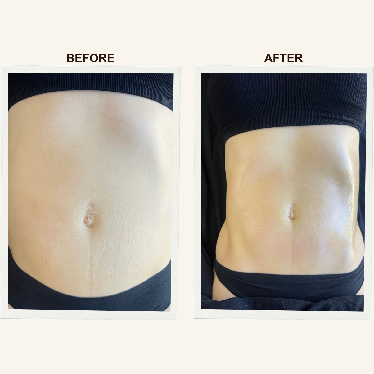 Abdomen before and after a Sculpting Lymphatic Massage session at KIKOSPA, San Diego.