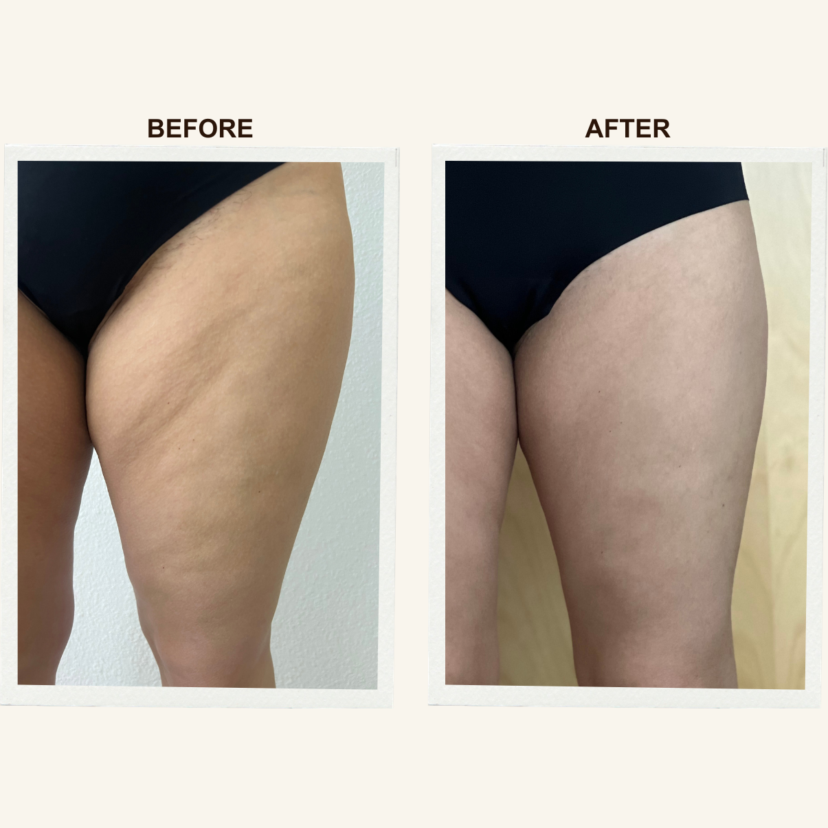 Leg contour results after a Sculpting Lymphatic Massage session at KIKOSPA