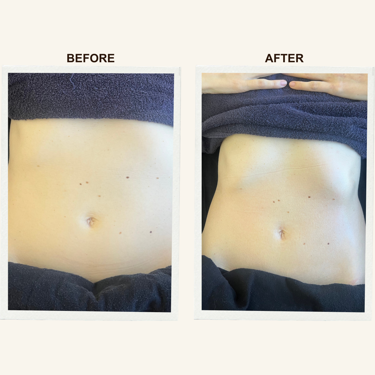 Abdomen results after Sculpting Lymphatic Massage at KIKOSPA, San Diego.
