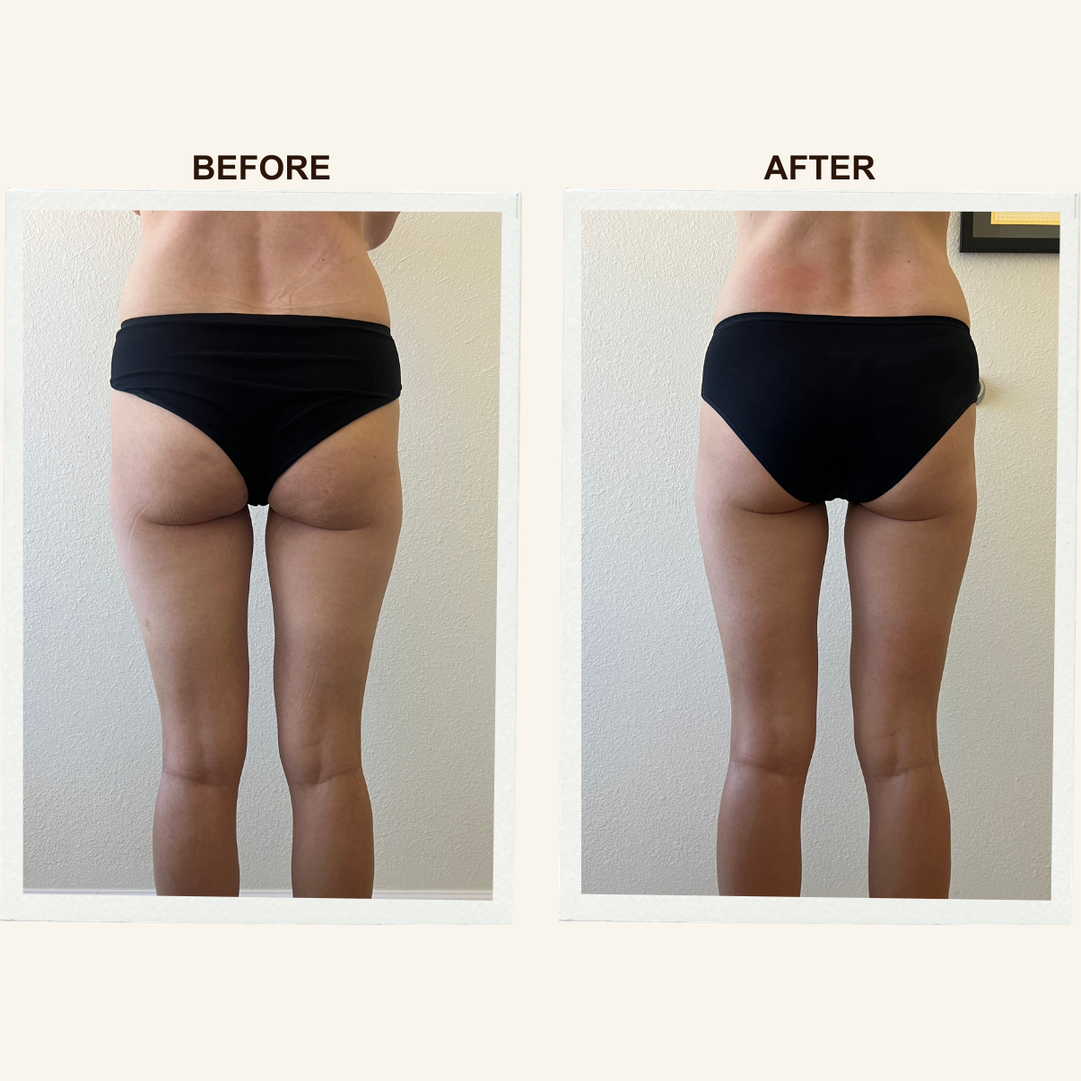 Thigh and leg results after Sculpting Lymphatic Massage at KIKOSPA.