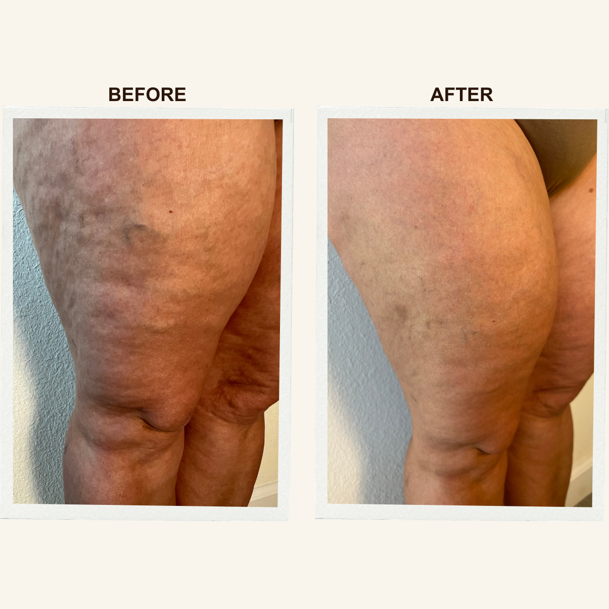 Client results after a Sculpting Lymphatic Massage session at KIKOSPA.