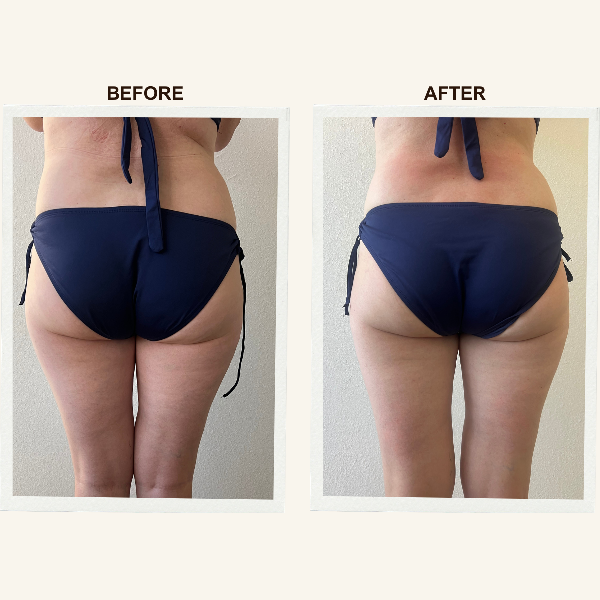 Lower back results after Sculpting Lymphatic Massage at KIKOSPA, San Diego