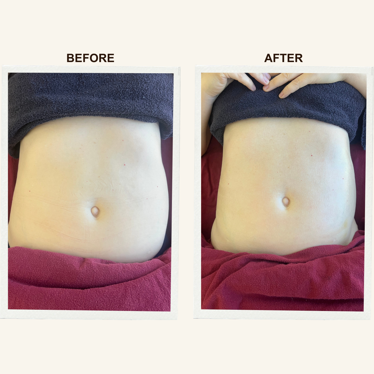 Abdomen results after Sculpting Lymphatic Massage at KIKOSPA, San Diego
