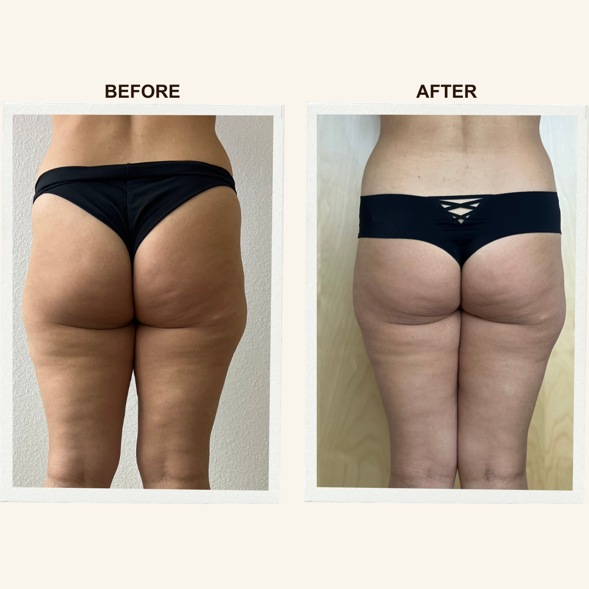 Client results after a Sculpting Lymphatic Massage session at KIKOSPA.