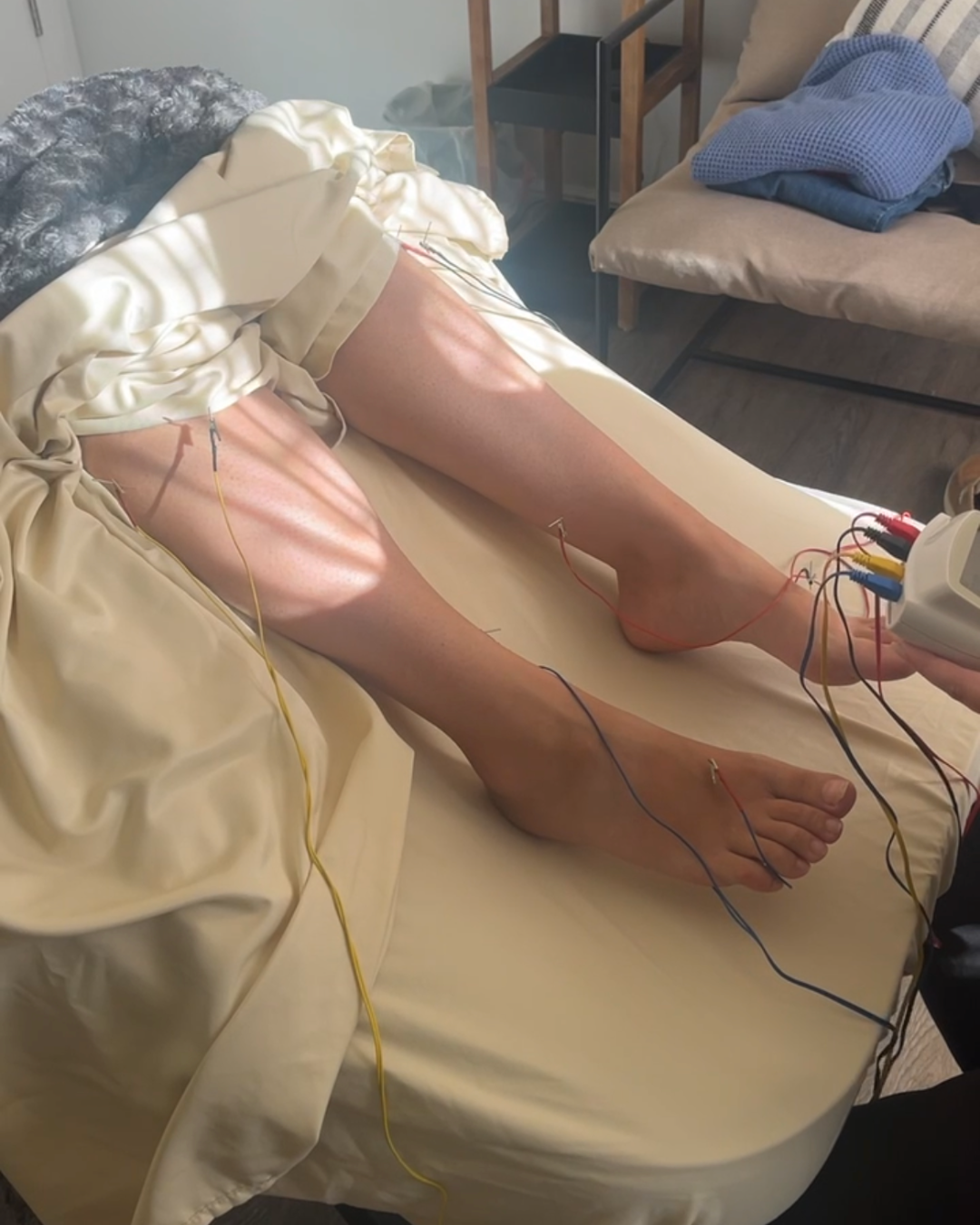 electrostimulation acupuncture for labour induction