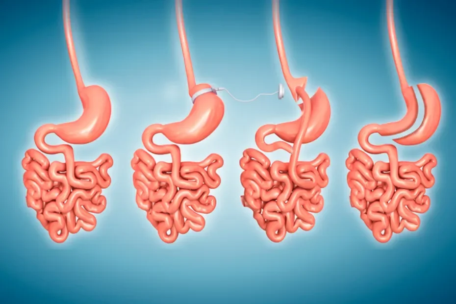 Bariatric Surgery To Help People Lose Weight 