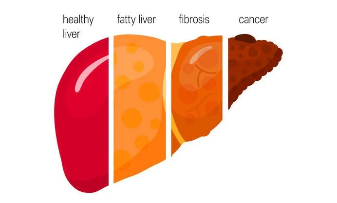 Can I Fix My Liver Through My Diet ?