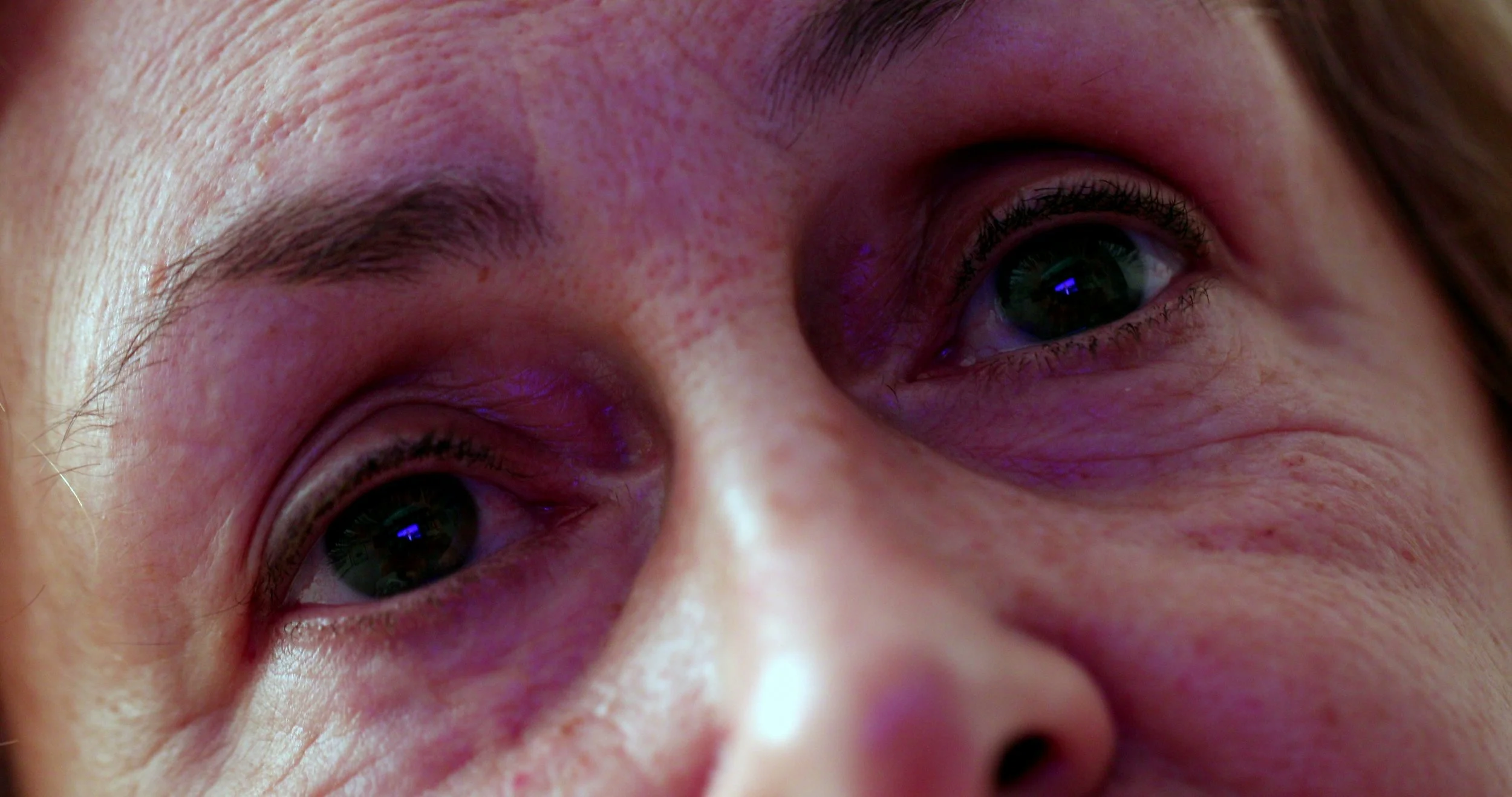 Dark Under Eyes Are Not Always “Just Tiredness”