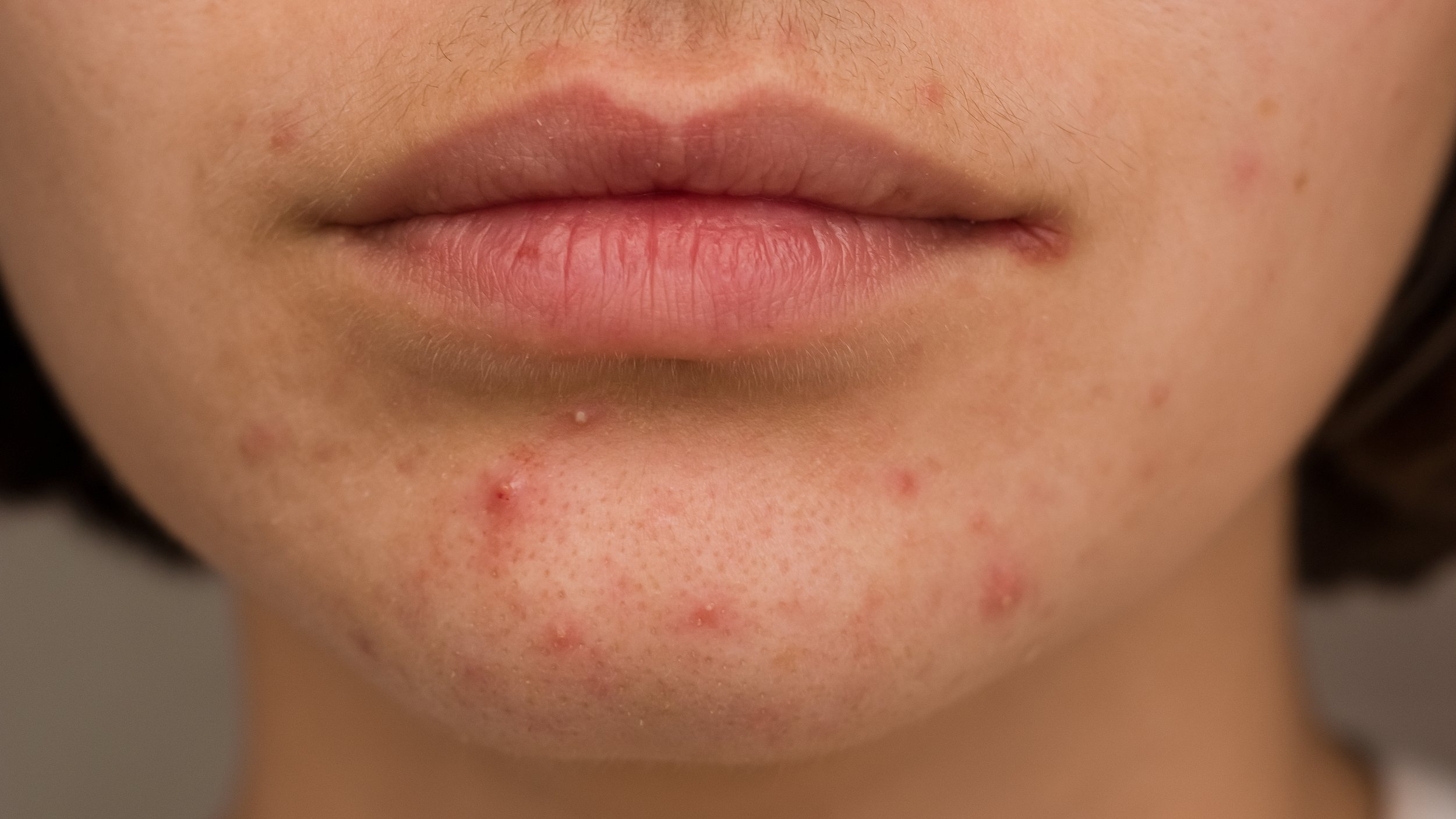 Chin Breakouts Are Not Always Just “Bad Skin”