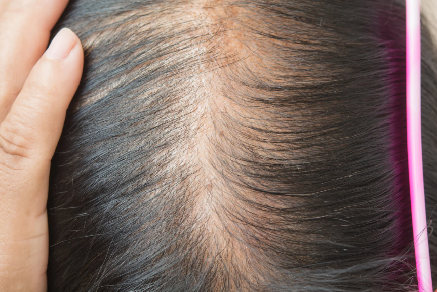 Why Is My Hair Thinning?