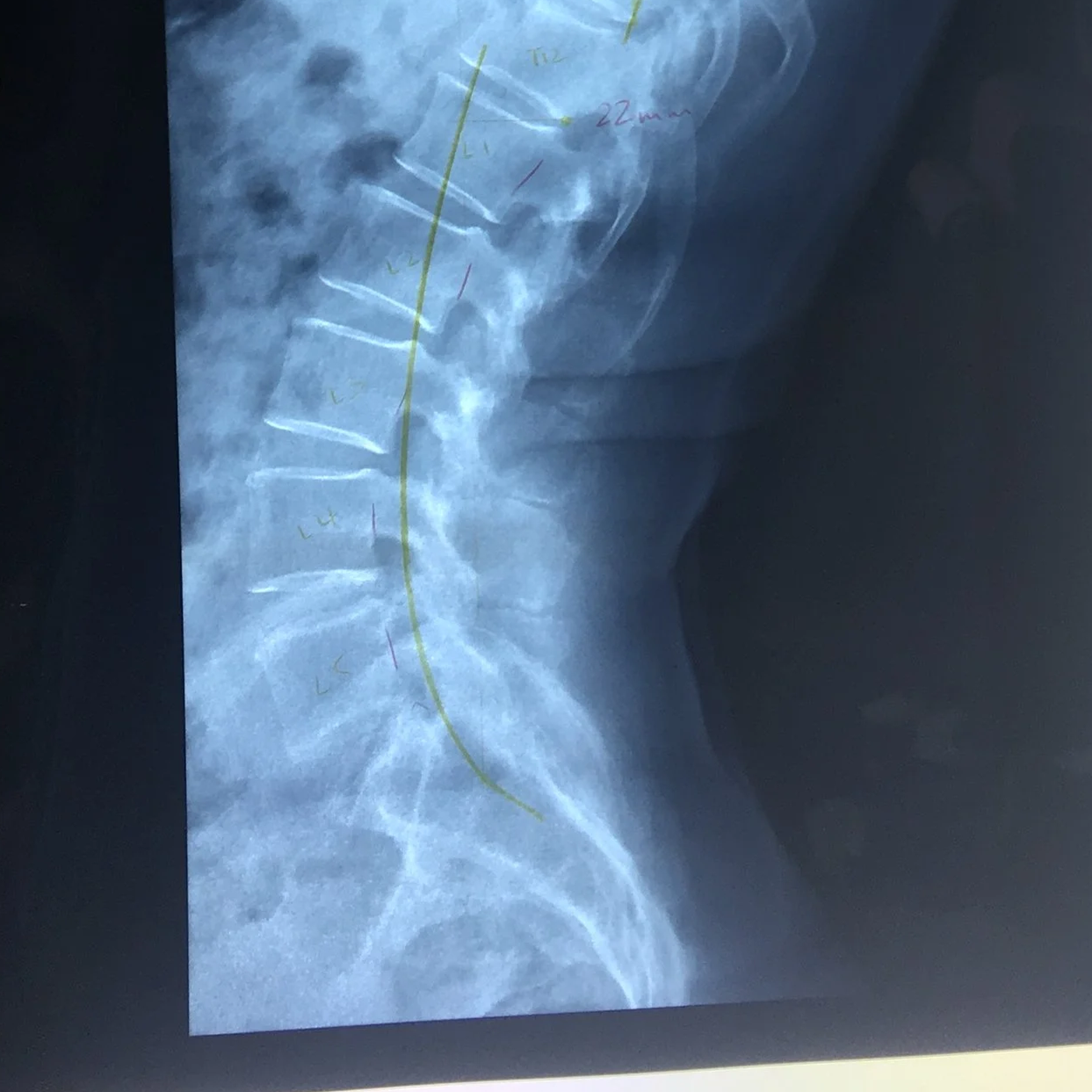 Lower Limb Pinched Nerves: Understanding Sciatica, Femoral Nerve Pain, Meralgia Paresthetica and Leg Numbness