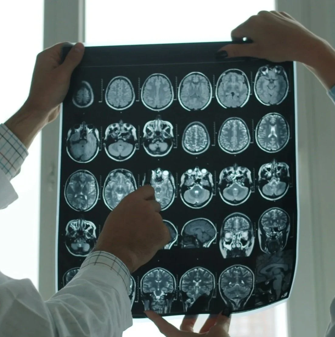 Understanding Concussion: What Happens to Your Brain and Why Symptoms Matter