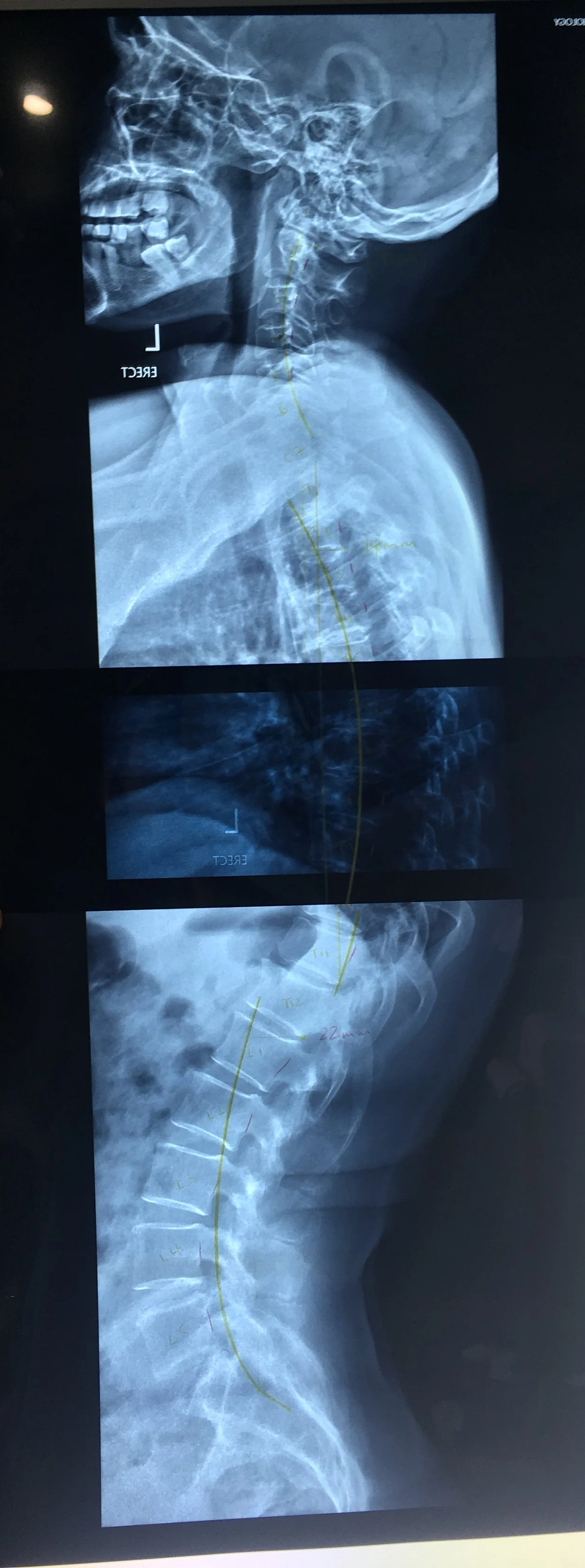 disc hernation treatment mosman