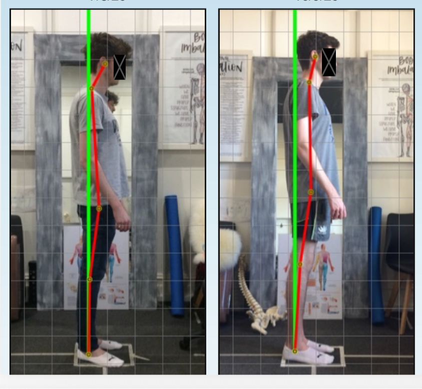 Before and after posture correction – forward head posture and rounded shoulders improvement