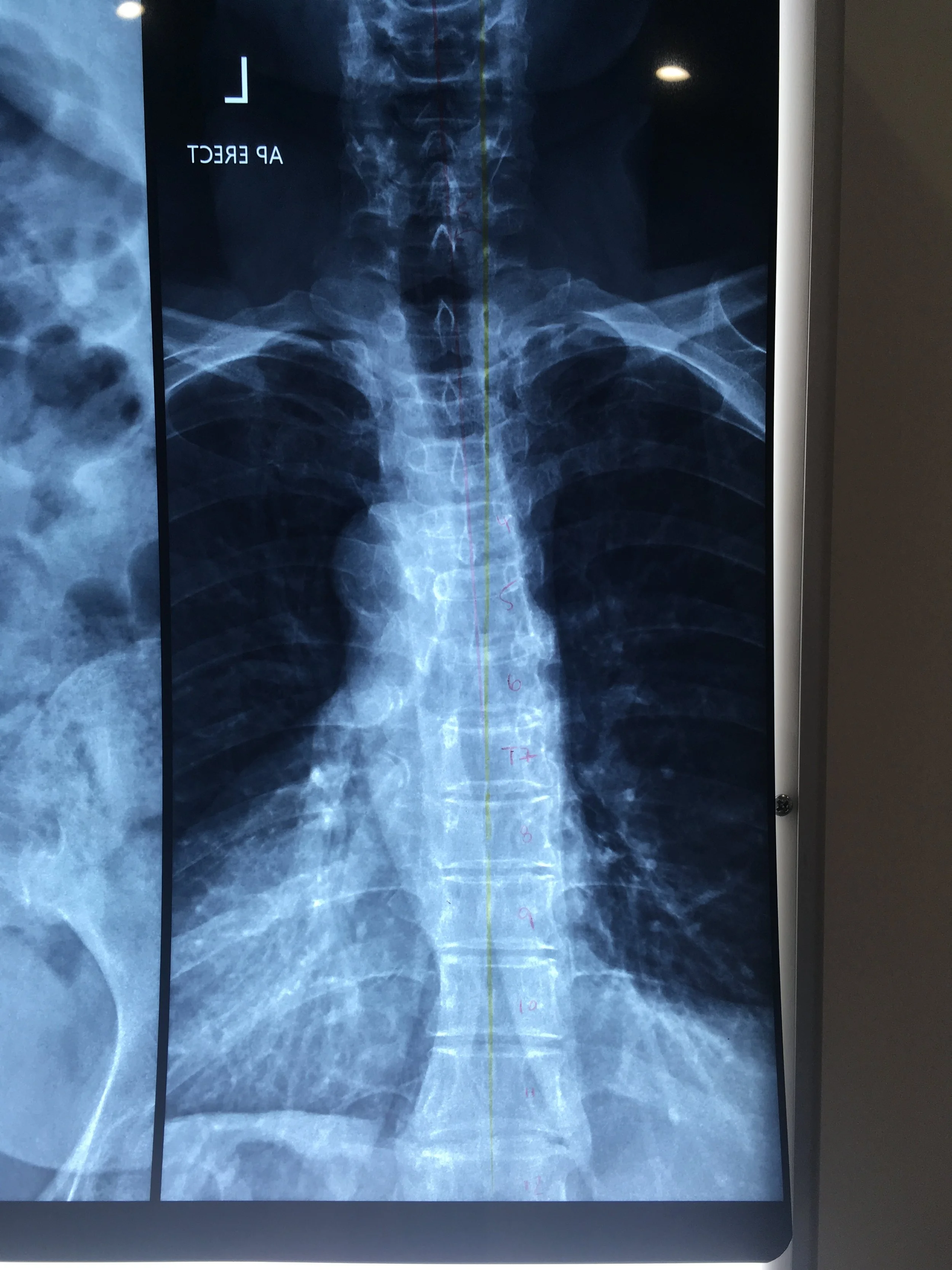 scoliosis chiropractor mosman