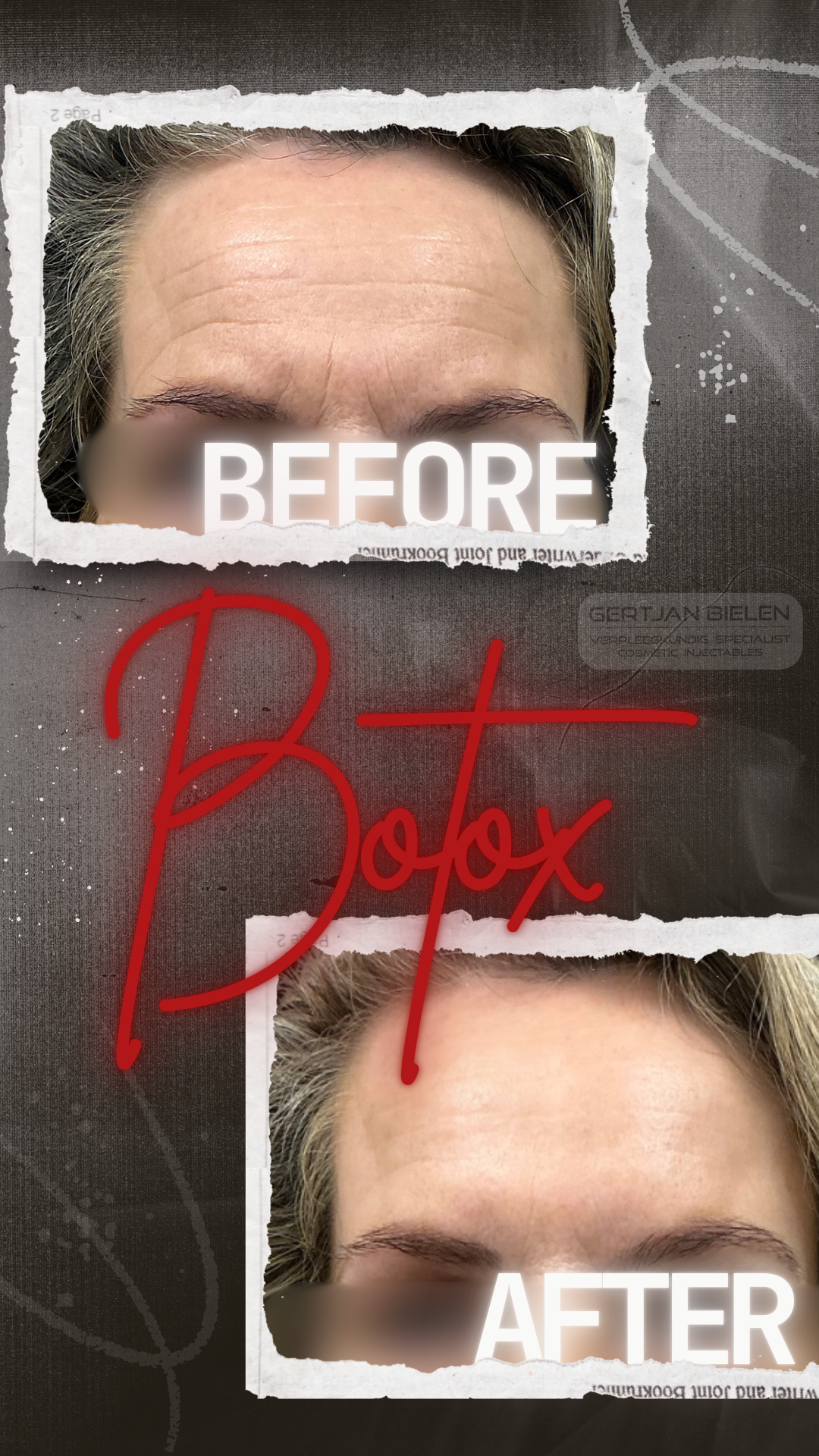 "Voor- en na-foto van een botox behandeling voor het voorhoofd en de fronsrimpel bij een vrouw, uitgevoerd door CliniQ InjectiQ in Heerlen."