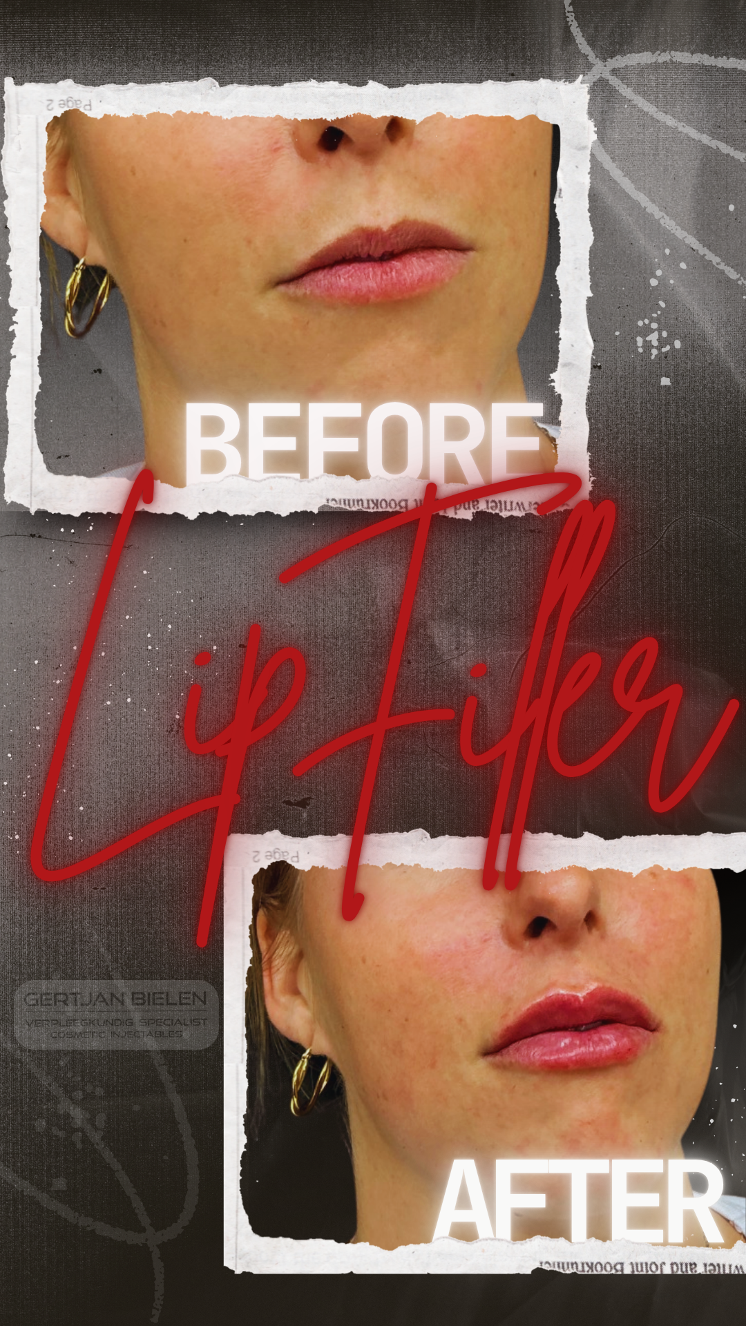 Lipfiller 0,8ml voor en na