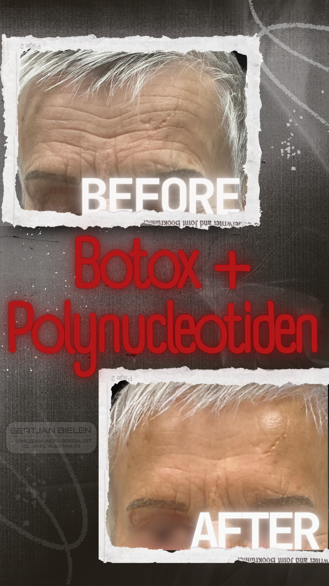 "Voor en na resultaat van een gecombineerde behandeling met botox en polynucleotiden voor het voorhoofd en de fronsrimpel bij CliniQ InjectiQ."