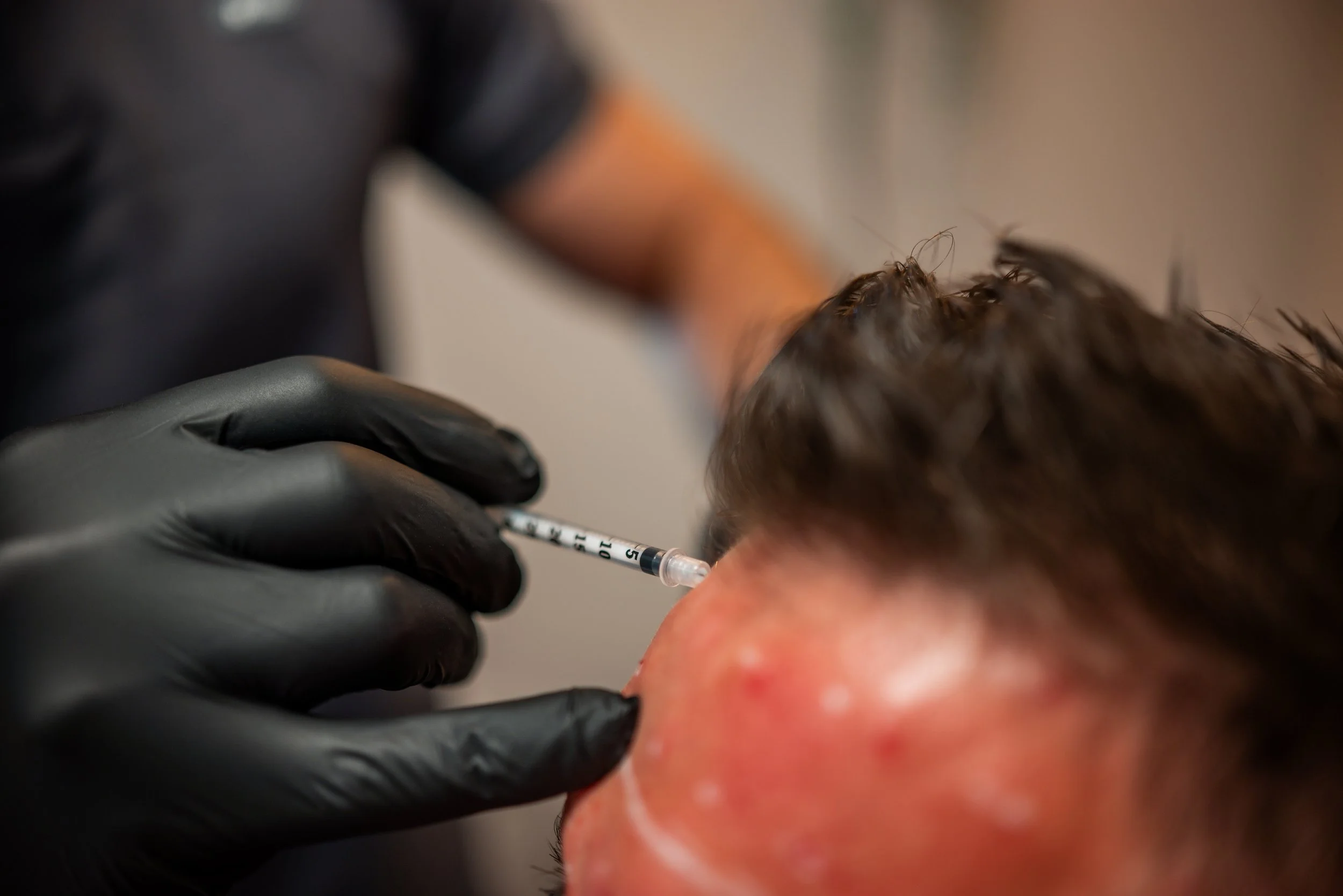 Cosmetische injectie uitgevoerd met aandacht voor comfort en pijnvermindering, als onderdeel van de no pain all gain aanpak bij CliniQ InjectiQ in Heerlen