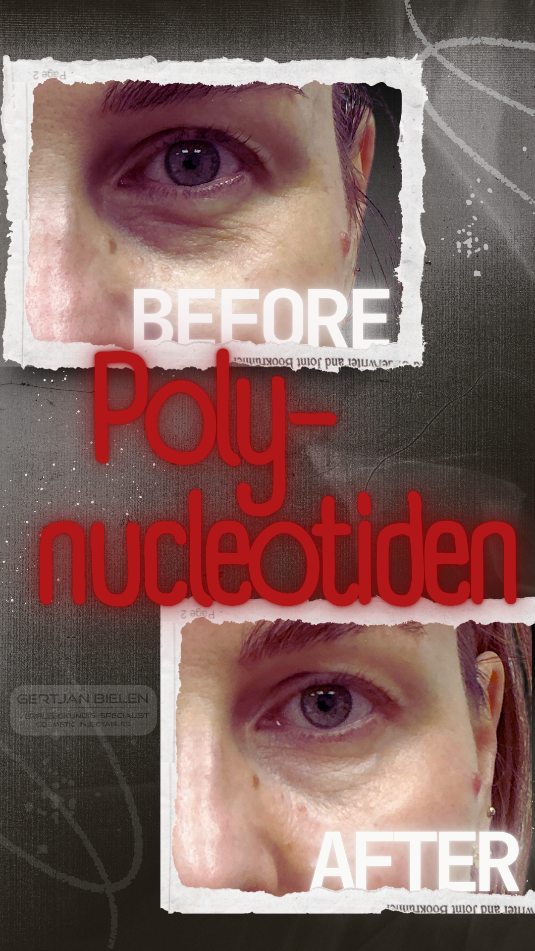 "Voor- en na-foto van een huidverbeterende behandeling met polynucleotiden onder de ogen bij CliniQ InjectiQ."
