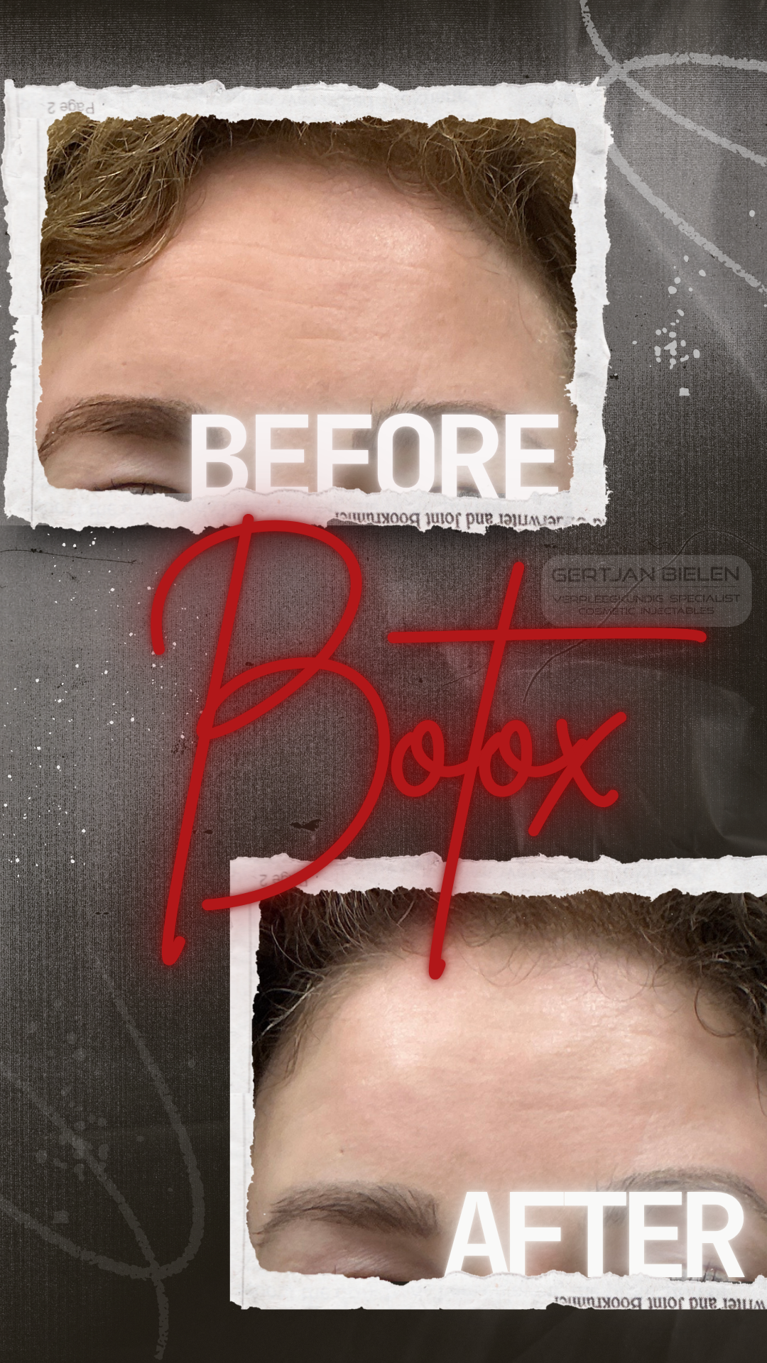 Voor en na resultaat van een subtiele botox behandeling tegen voorhoofdrimpels bij CliniQ InjectiQ in Heerlen."
