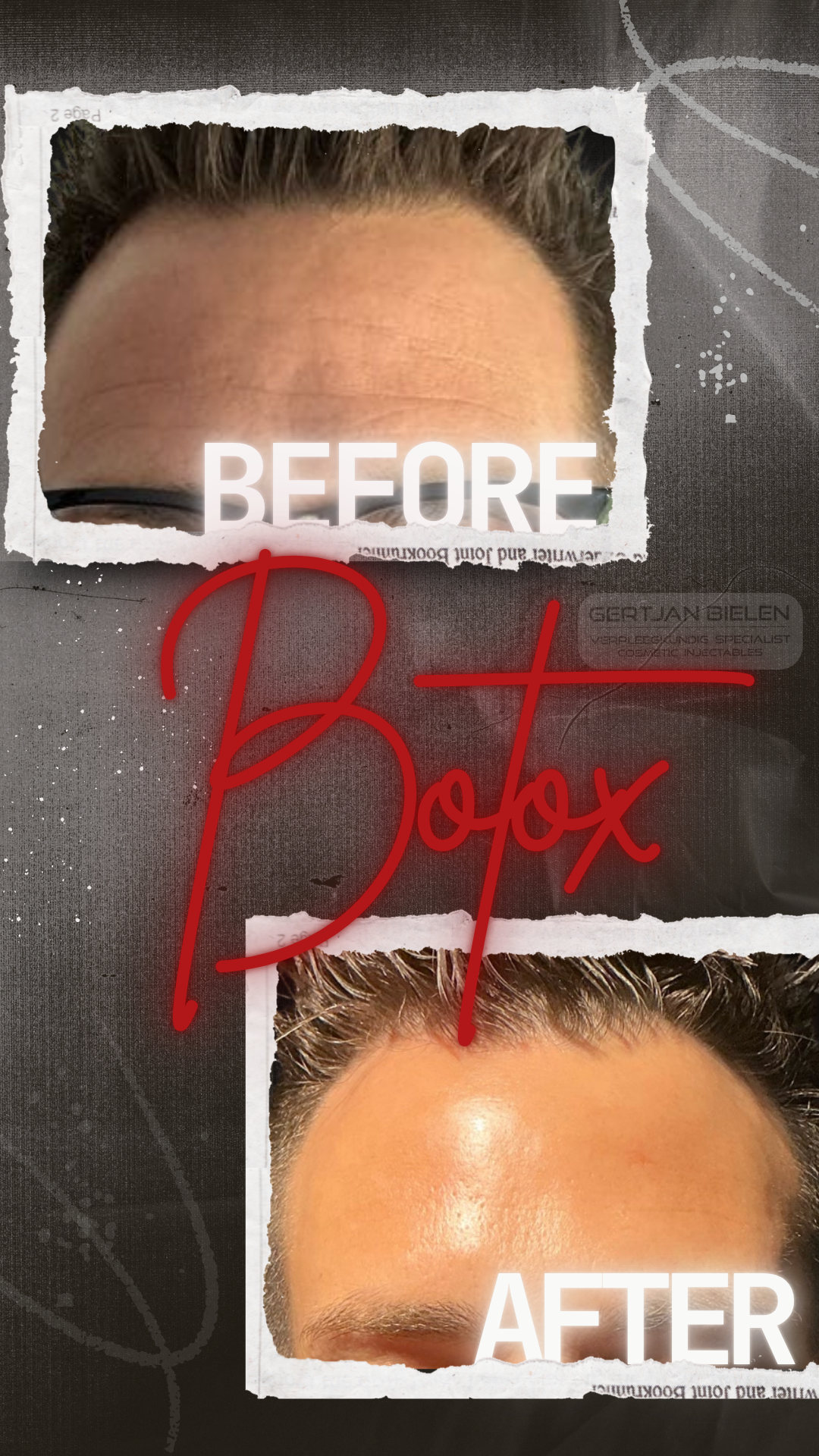 "Subtiel voor- en na-resultaat van een botox behandeling voor het voorhoofd en de fronsrimpel bij een man, uitgevoerd door CliniQ InjectiQ in Heerlen."