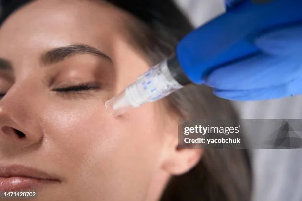 A woman receiving a facial treatment with a syringe-like device near her cheek.