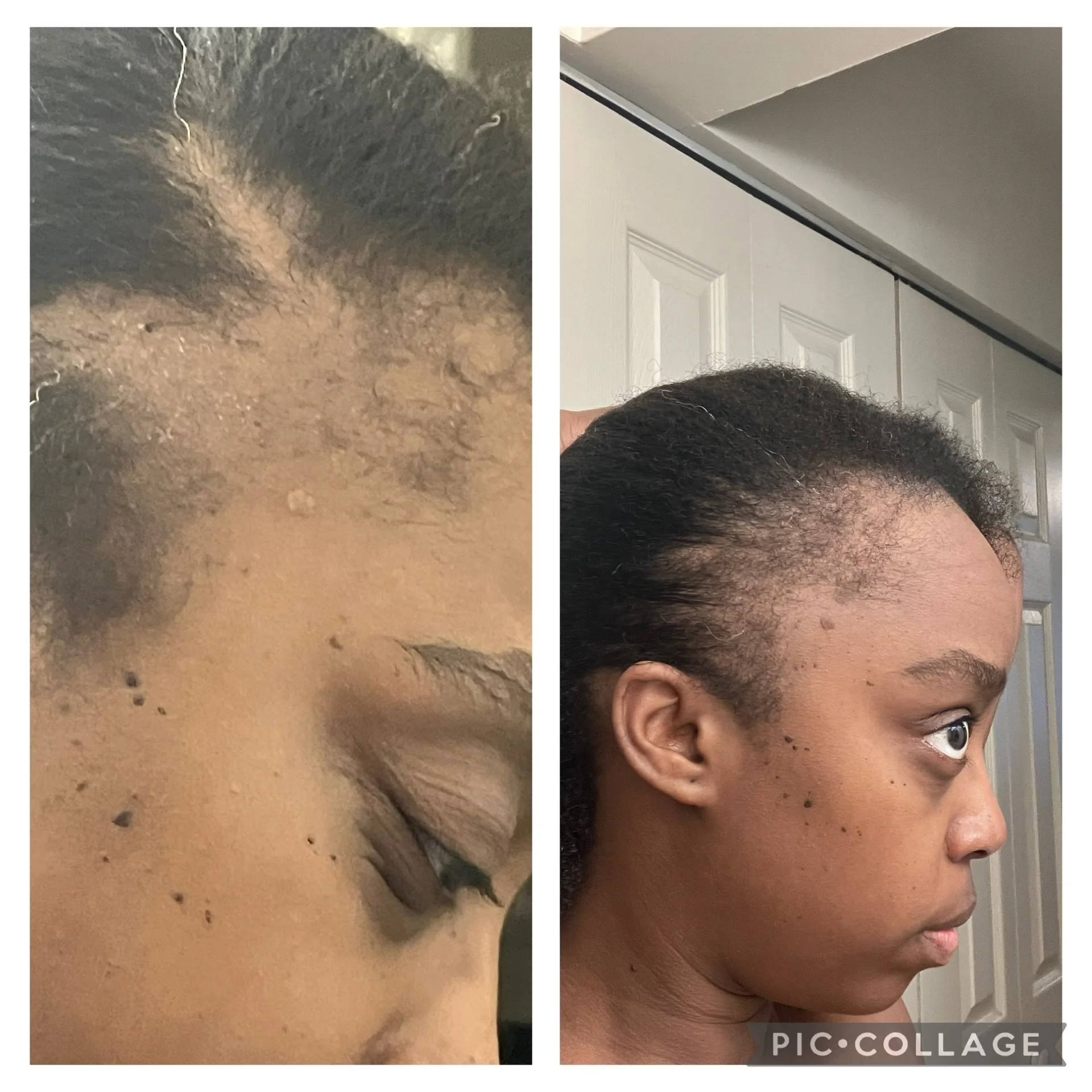 I remember it like it was yesterday. One random day in February, I woke up, and my hair started falling out. At first, it wasn’t much. I was dramatic about it—but if you know me, you know how much hair I have. I call it my lion’s mane. So