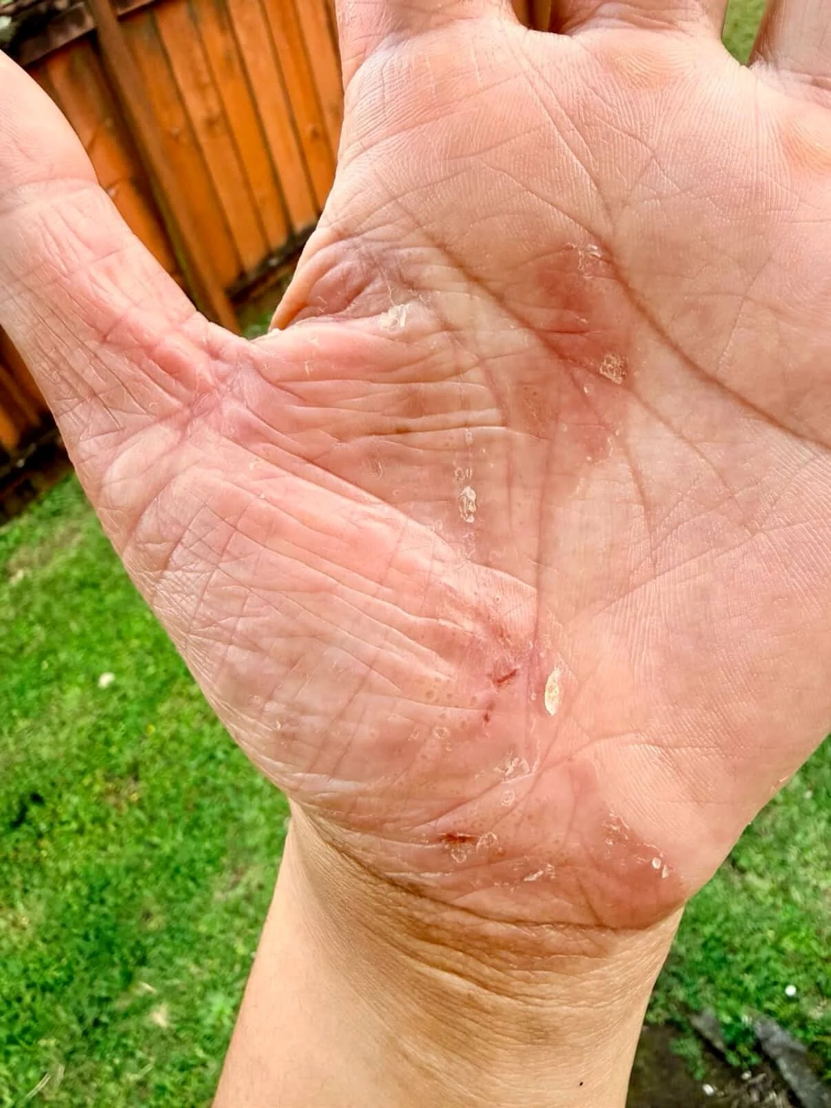 Before &amp; After✨| Our customer has very sensitive skin and has to be extra careful about what products they use, so trying our hemp seed oil soaps was a big risk for them. But as you can see, the results speak for themselves from flaking, red, and