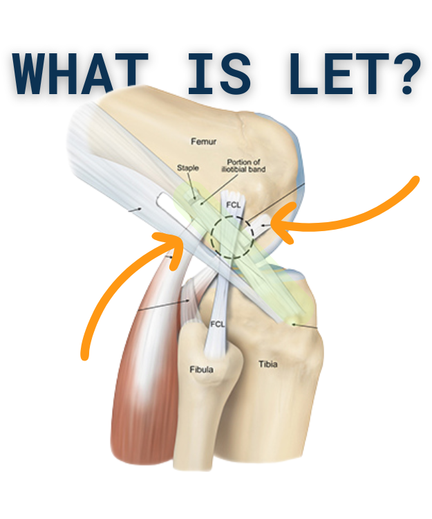 What Is Lateral Extra-Articular Tenodesis (LET) — and Why Is It Performed With ACL Surgery?