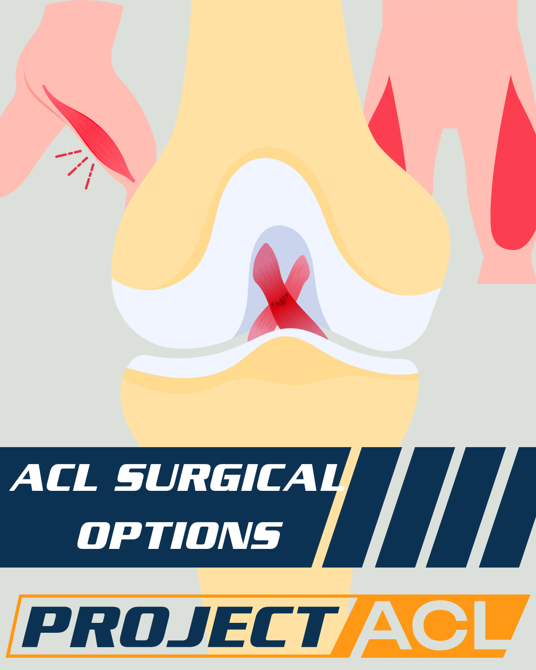 Understanding ACL Surgery: The Most Common Types of ACL Reconstruction Procedures