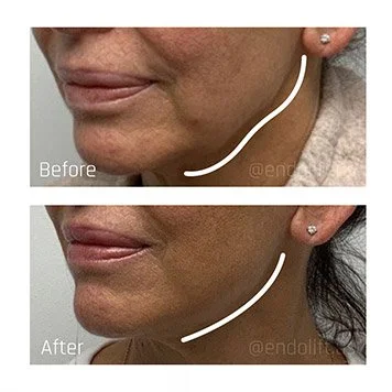 Why Endolift is My Favourite Tool to Define the Jawline