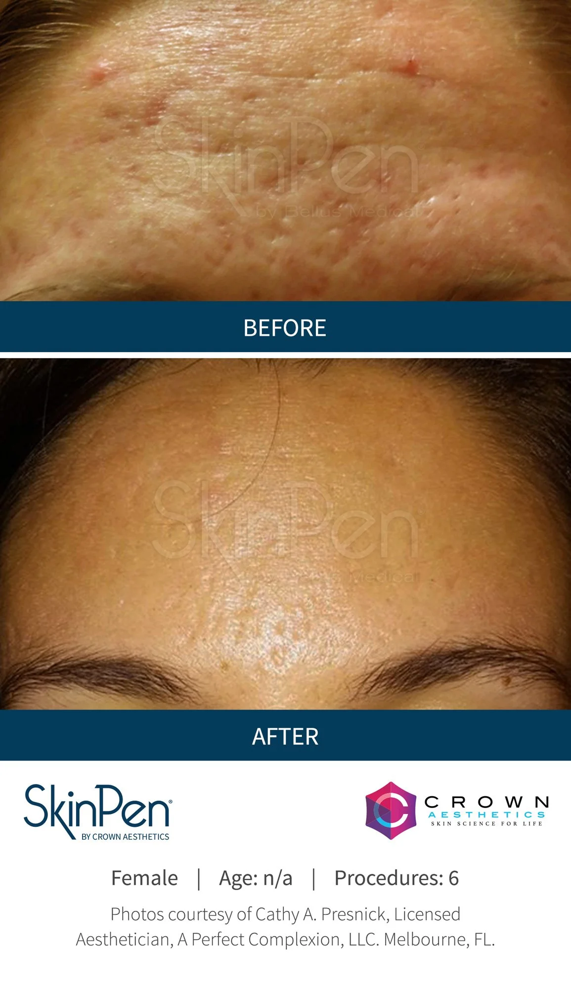 A before and after comparison of skin treatment on the forehead. The before photo shows skin with acne scars, redness, and uneven texture. The after photo shows smoother, clearer skin with an even tone and reduced scars.