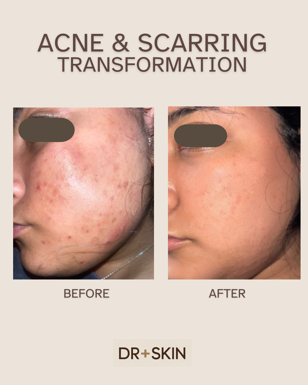 Before and after images showing improvement in acne and scarring on a woman's cheek. The left image depicts the skin with acne, redness, and scars, while the right image shows clearer and smoother skin post-treatment.