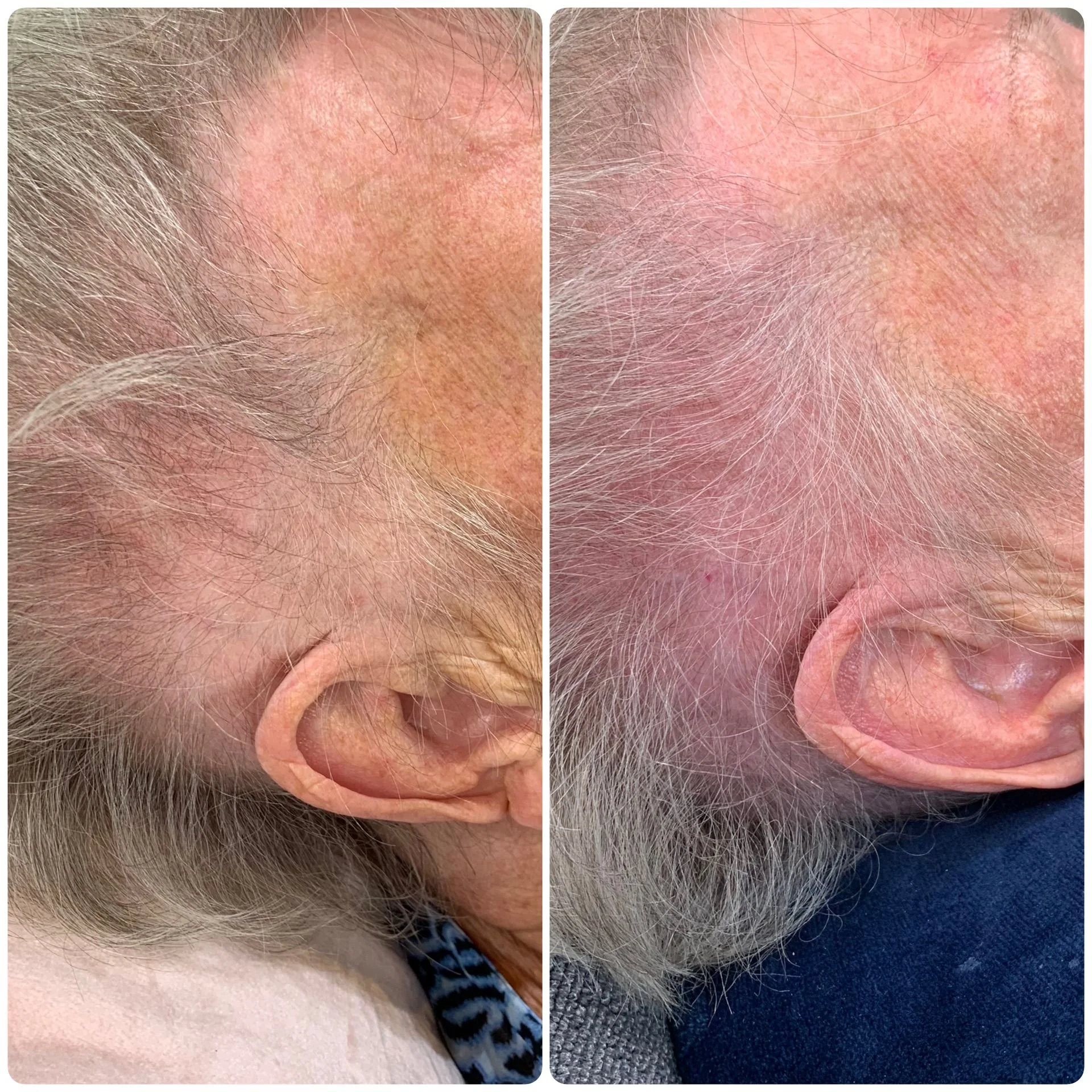 Hair Filler & Microneedling results after 1 month (before) and 3 months (after).