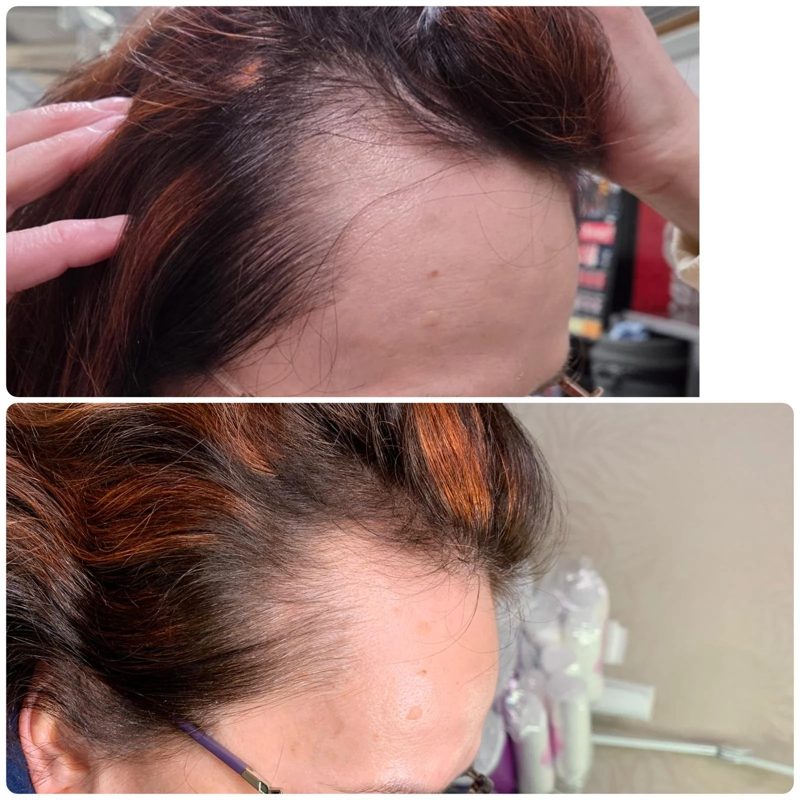 Microneedling Before & After
Results After 6 Sessions