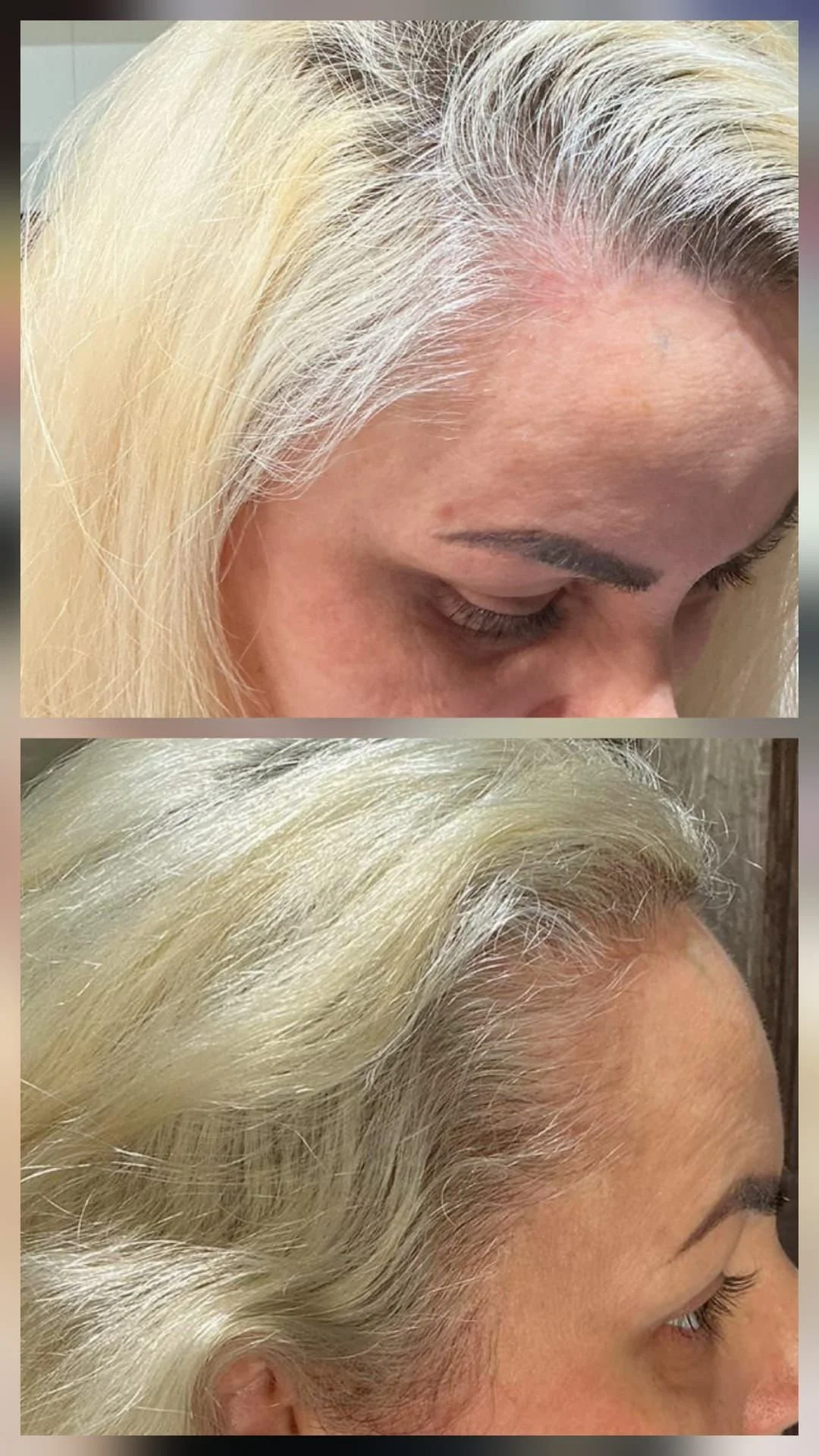 Hair Filler & Microneedling results after 1 month (before) and 3 months (after).