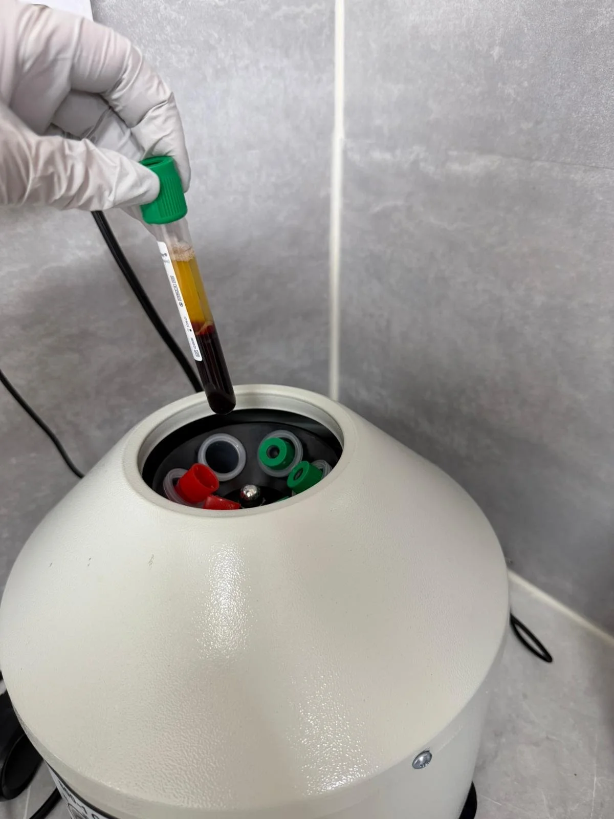 Preparing PRP Treatment