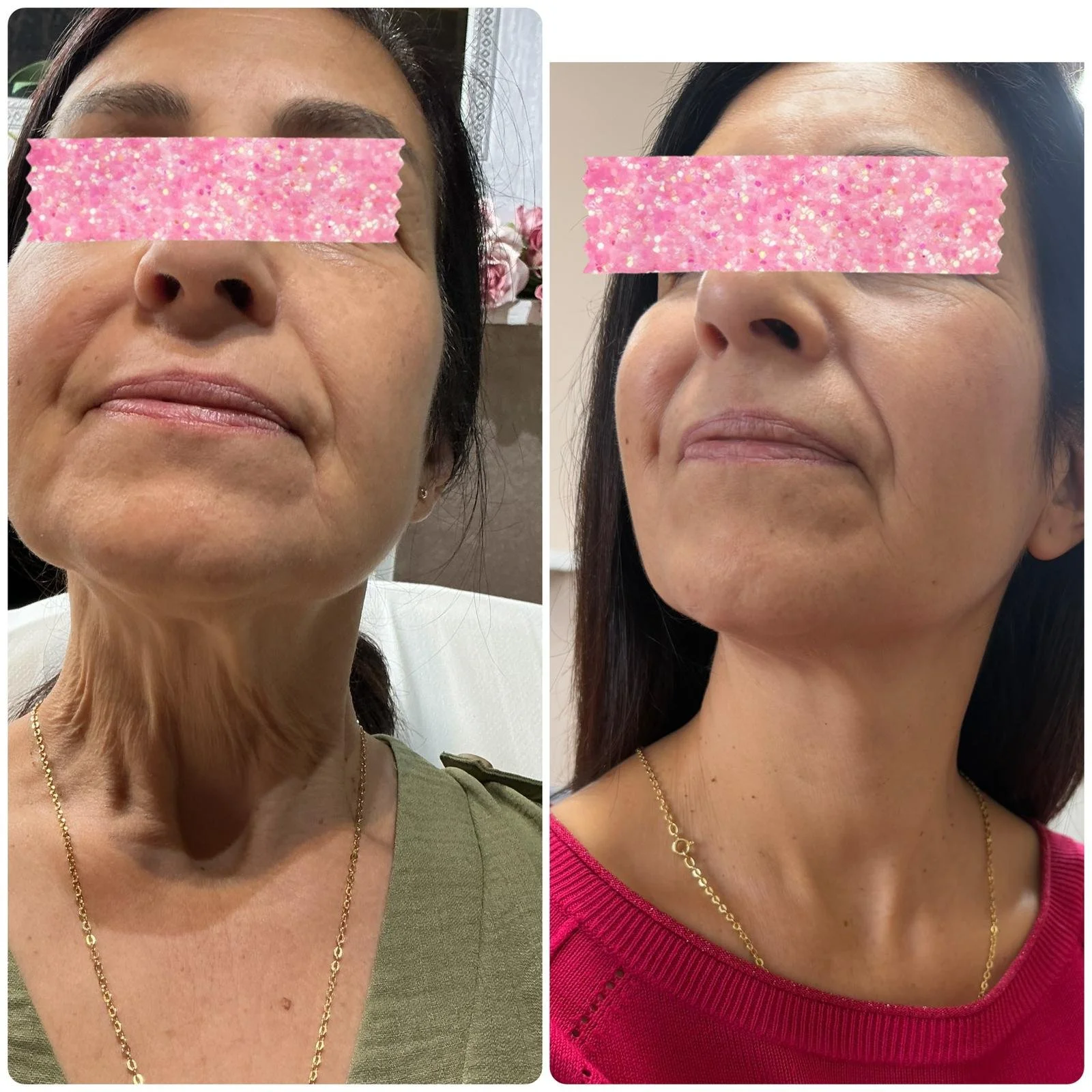 PRP after 3 treatments